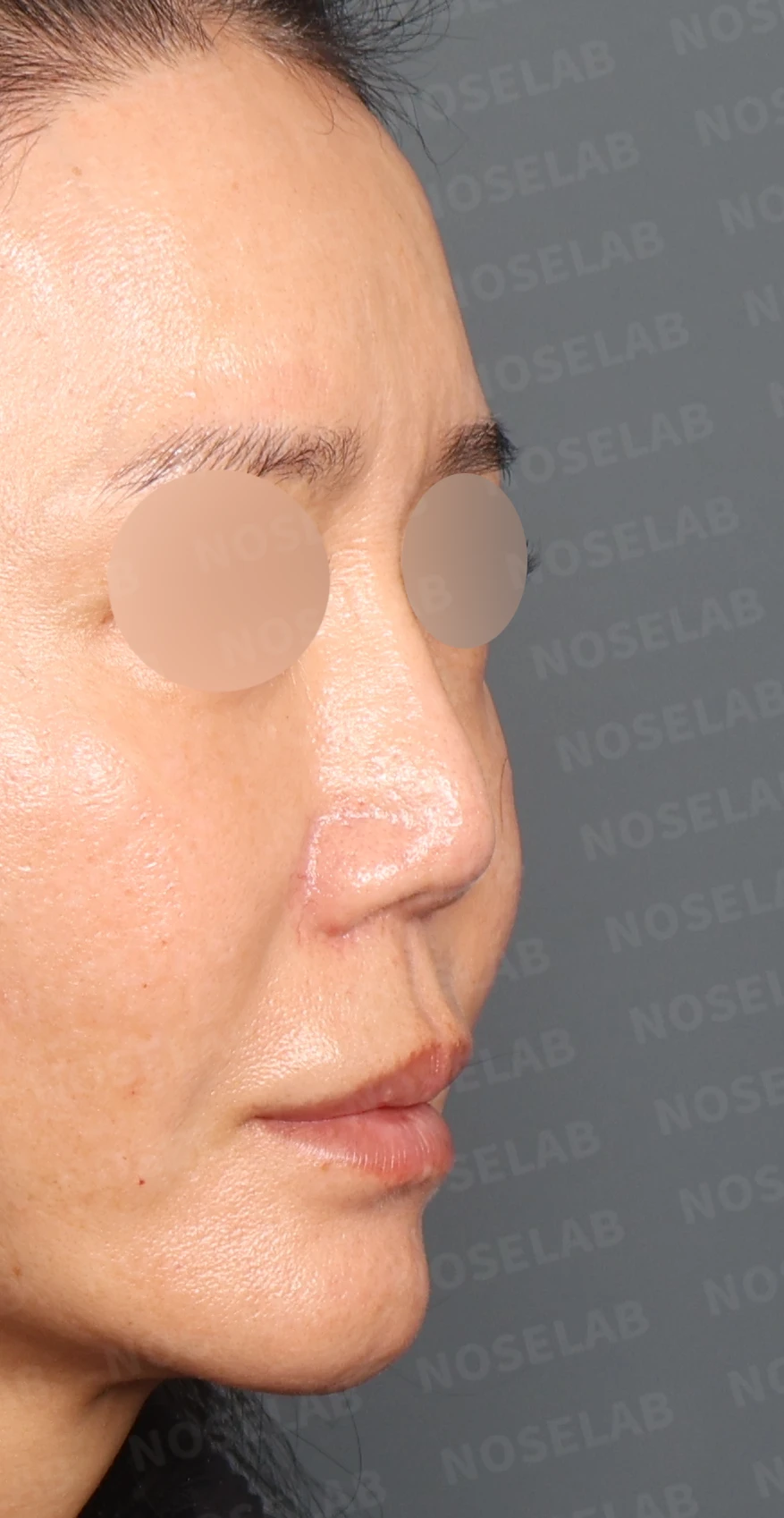 실리콘 재수술, 자가늑연골로 안전하게 코 라인 교정한 사례 — 디자인 상담 우측 측면, 비스듬한 측면, 비공 사진입니다.
