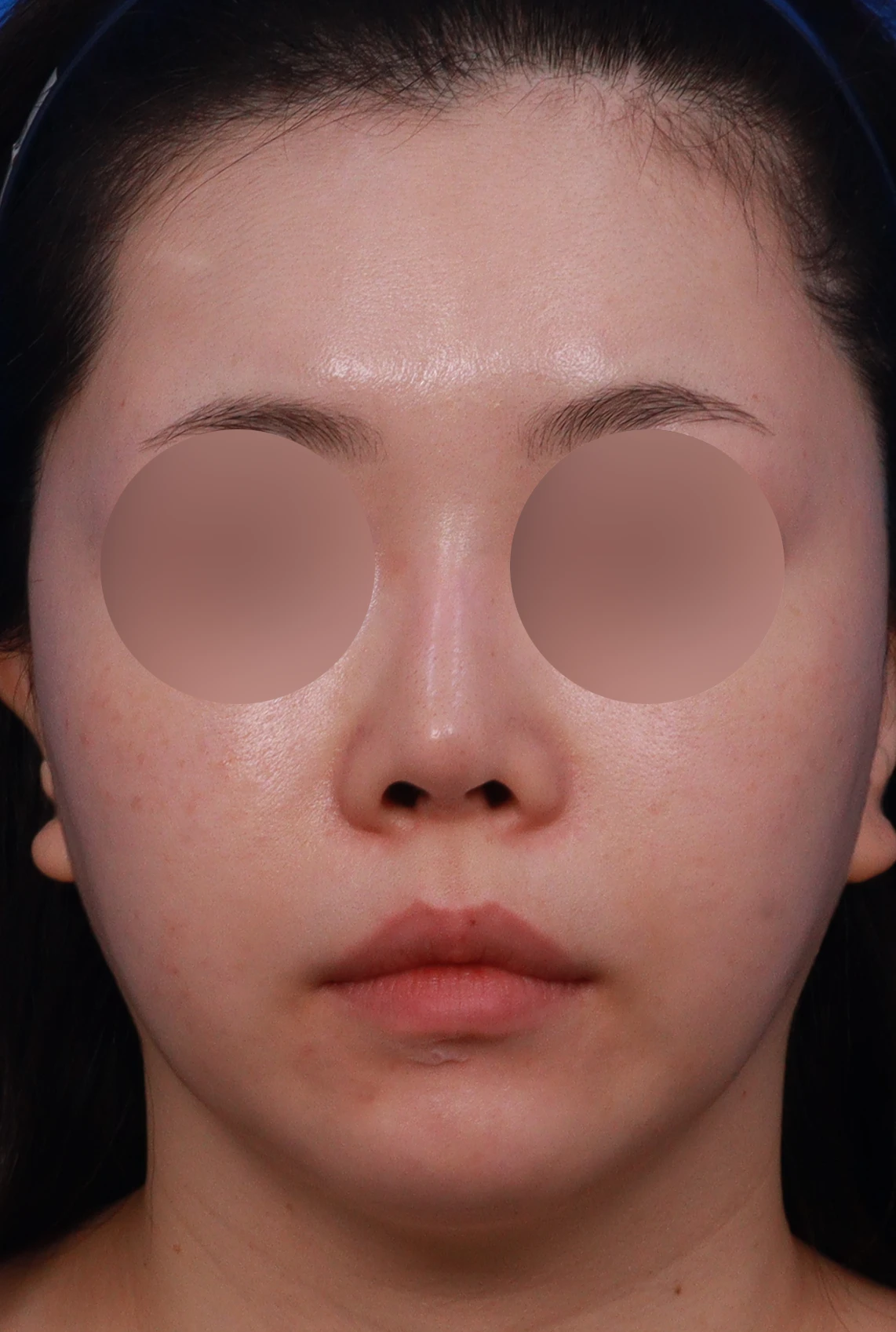 비중격 연골을 과도하게 채취하면 생기는 문제와 재건 방법 — 디자인 상담 정면, 좌측, 비스듬한 측면 사진입니다.