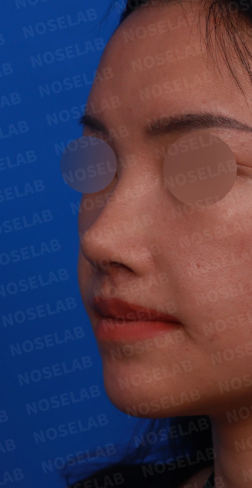 원하는 코 모양과 현재 구조를 함께 살펴보는 수술 계획 — 디자인 상담 정면, 좌측 비스듬한 측면, 측면 사진입니다.