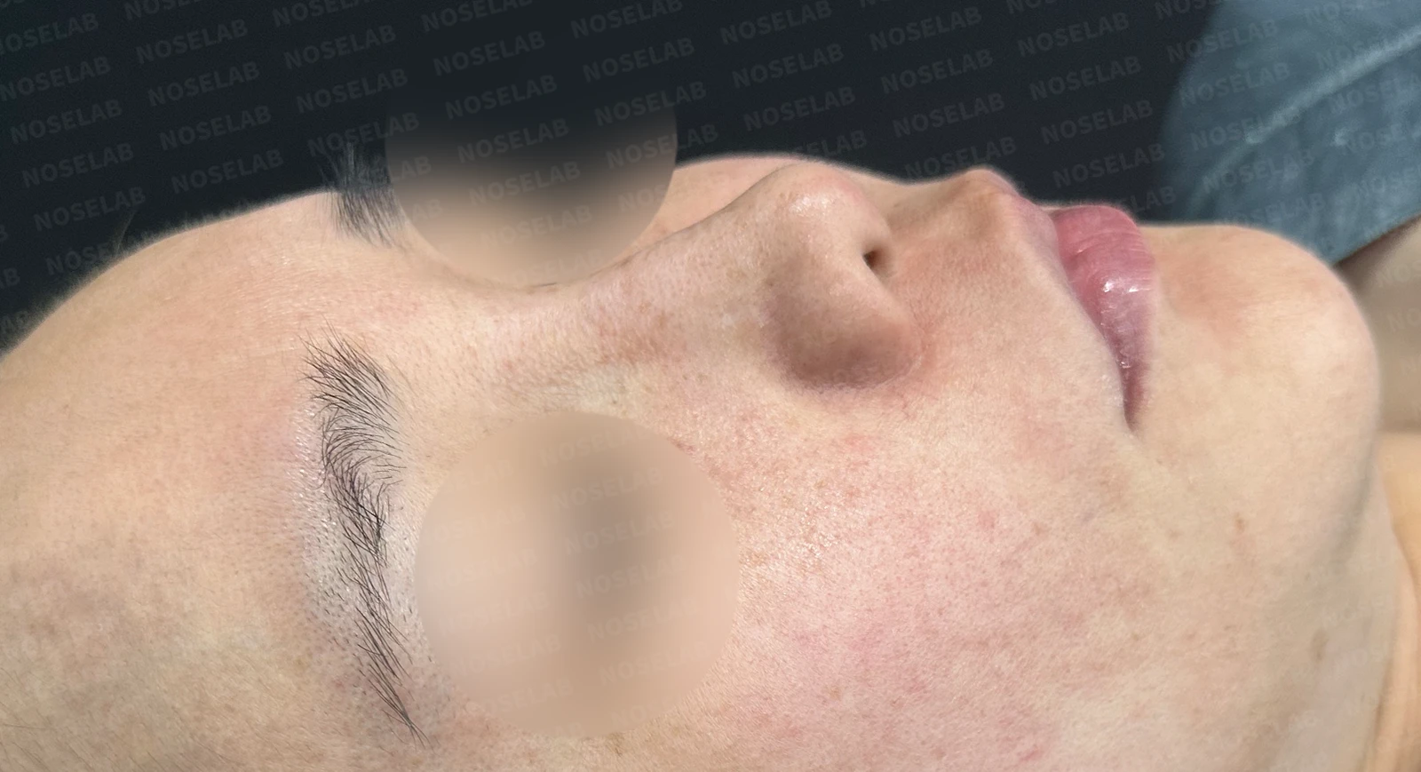 코에 주입된 칼슘필러의 제거와 재건 방법 — 수술 전 / 수술 직후 0일 직후 사진은 부기가 있는 상태로 최종 결과와 다를 수 있습니다.
