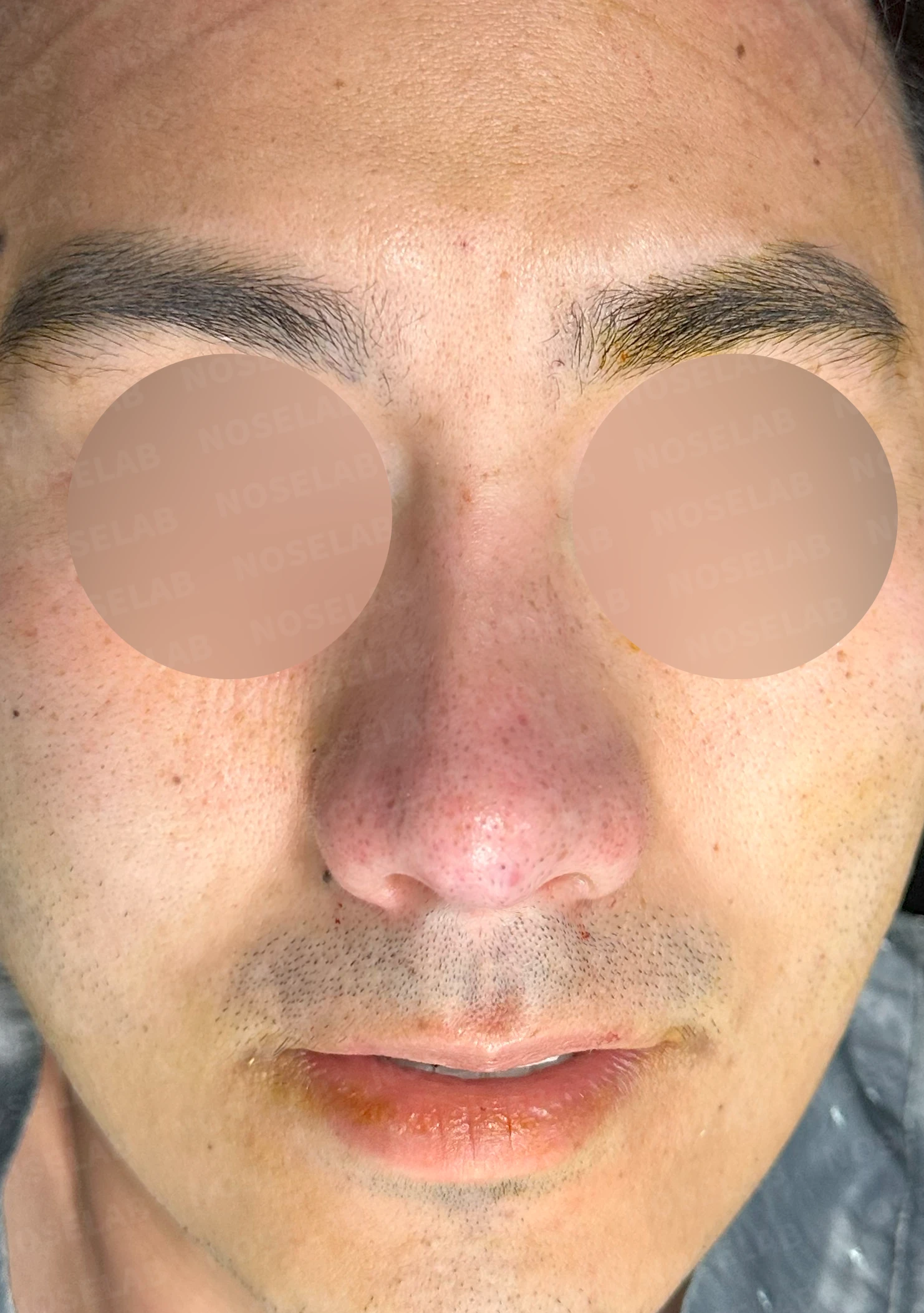 복코에 비공 비대칭과 코막힘이 함께 오는 이유, 직반 라인 교정은 어떻게 하나 — 수술 직후 0일 정면, 측면, 비스듬한 측면 사진 직후 사진은 부기가 있는 상태로 최종 결과와 다를 수 있습니다.