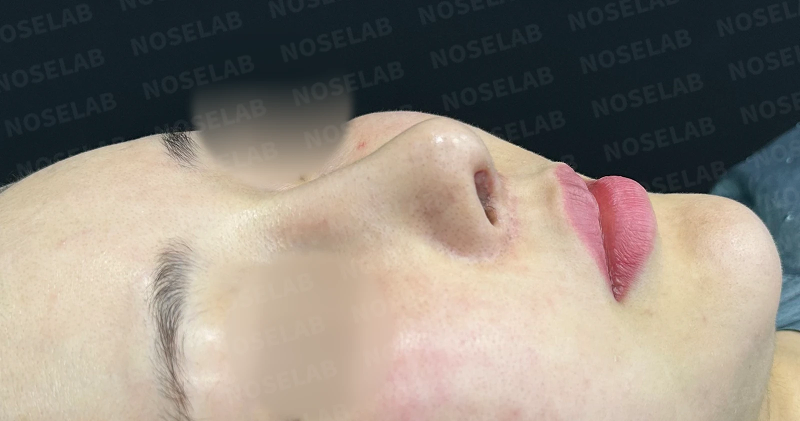 수술 후 14일 조기 교정에서 확인할 점 — 수술 전 / 수술 직후 0일 직후 사진은 부기가 있는 상태로 최종 결과와 다를 수 있습니다.