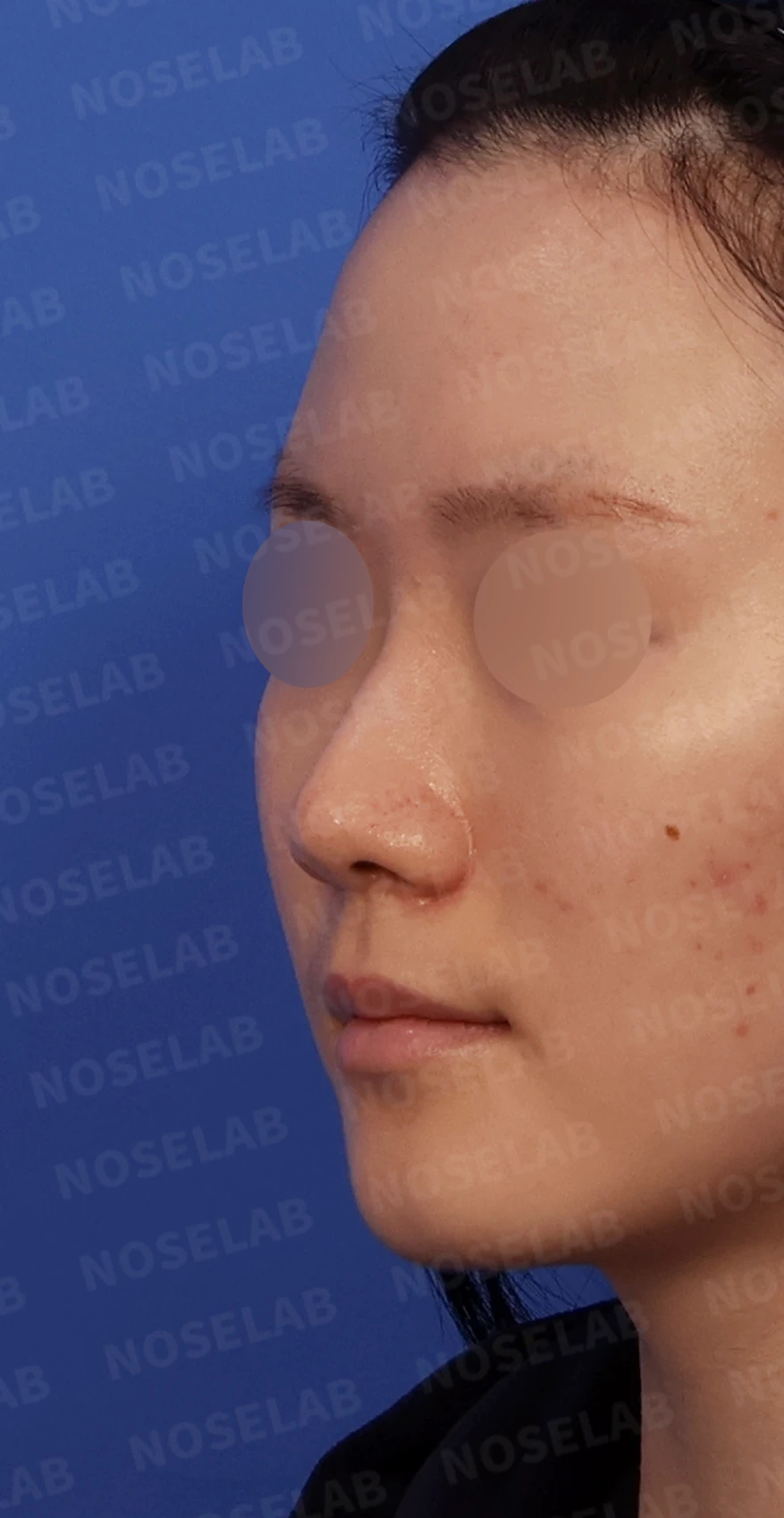 콧대가 퍼져 보이고 코끝이 뭉툭한 이유, 절골술과 자가 늑연골 교정은 어떻게 하나 — 디자인 상담 정면, 좌측 측면, 비스듬한 측면 사진입니다.