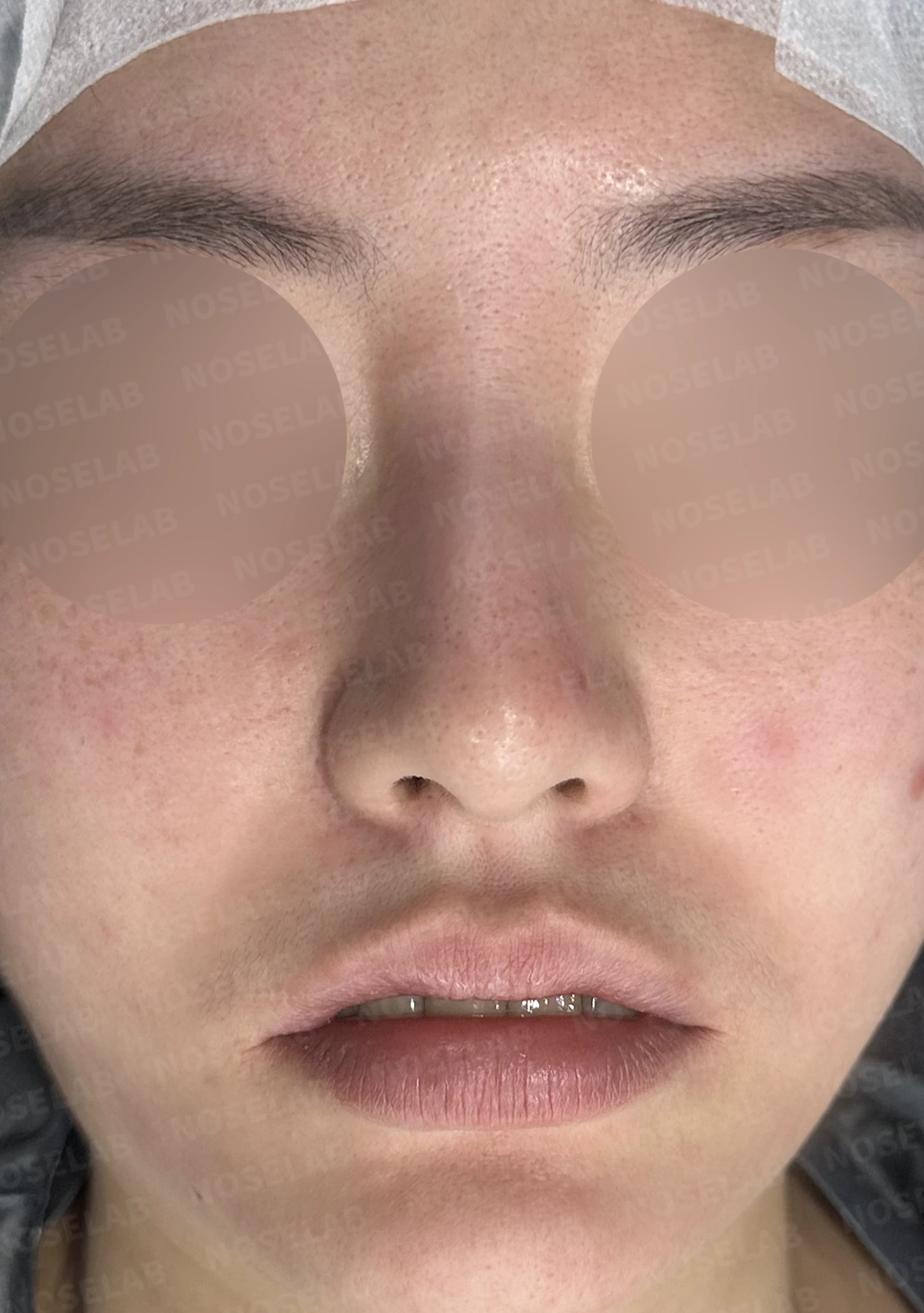 매부리코 교정, 자가늑연골로 자연스러운 코 라인 완성 — 전(좌) 직후(후)
