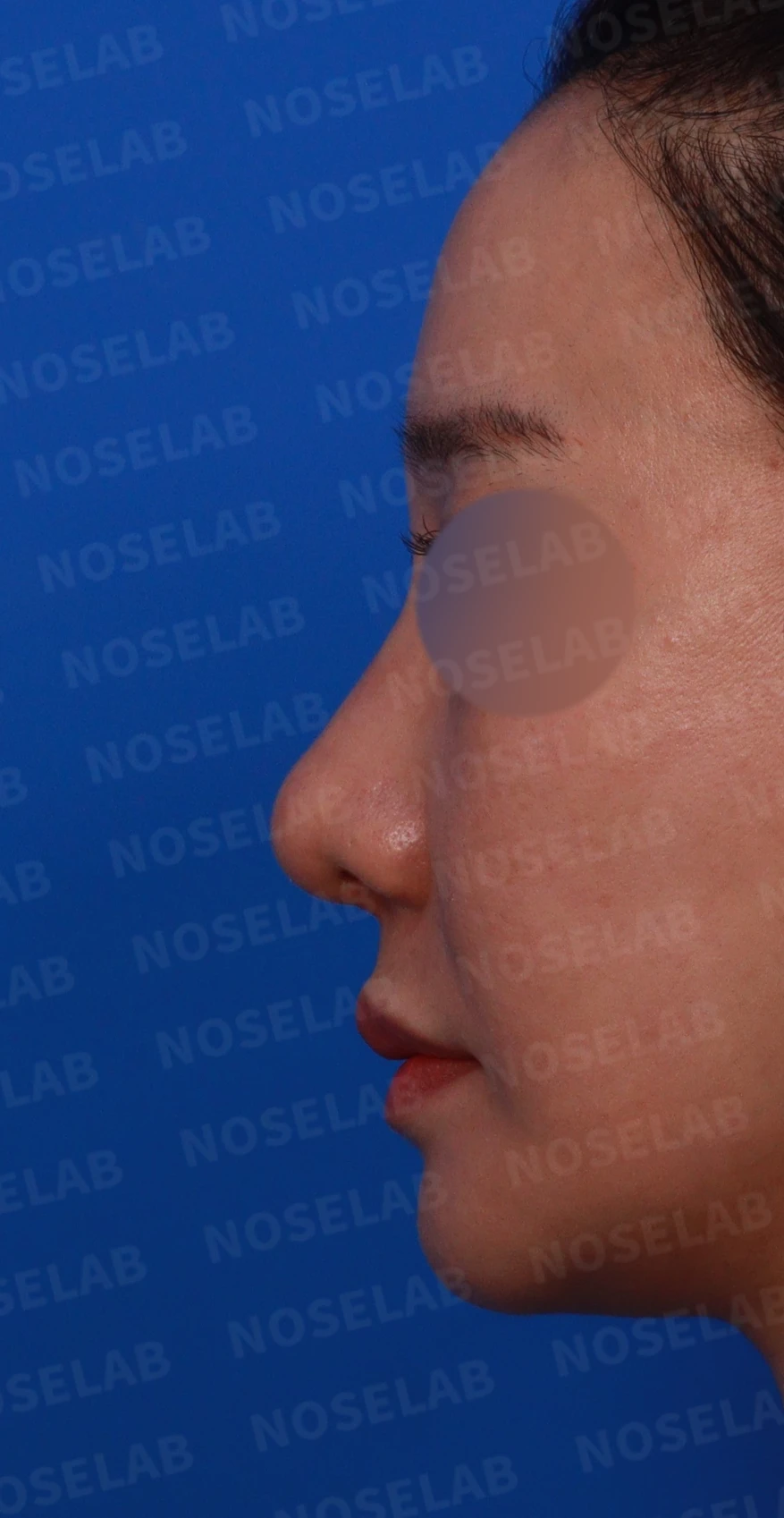 복코와 휜코의 구조를 살펴보는 교정 방법 — 디자인 상담 정면, 좌측 측면, 비스듬한 측면