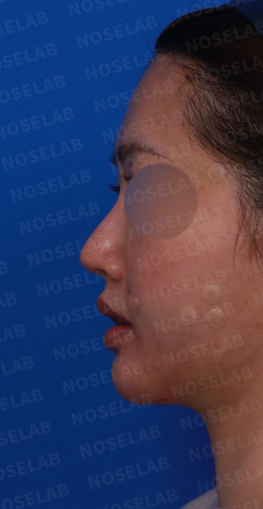 재수술한 코가 휘어 보이고 코끝이 처지는 이유 — 디자인 상담 정면, 좌측 측면, 비스듬한 측면 사진