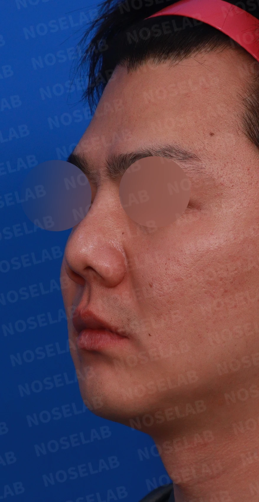 콧구멍 비대칭과 들린 코가 함께 생기는 이유, 늑연골 재건은 어떻게 하나 — 디자인 상담 정면, 좌측 측면, 비스듬한 측면 사진