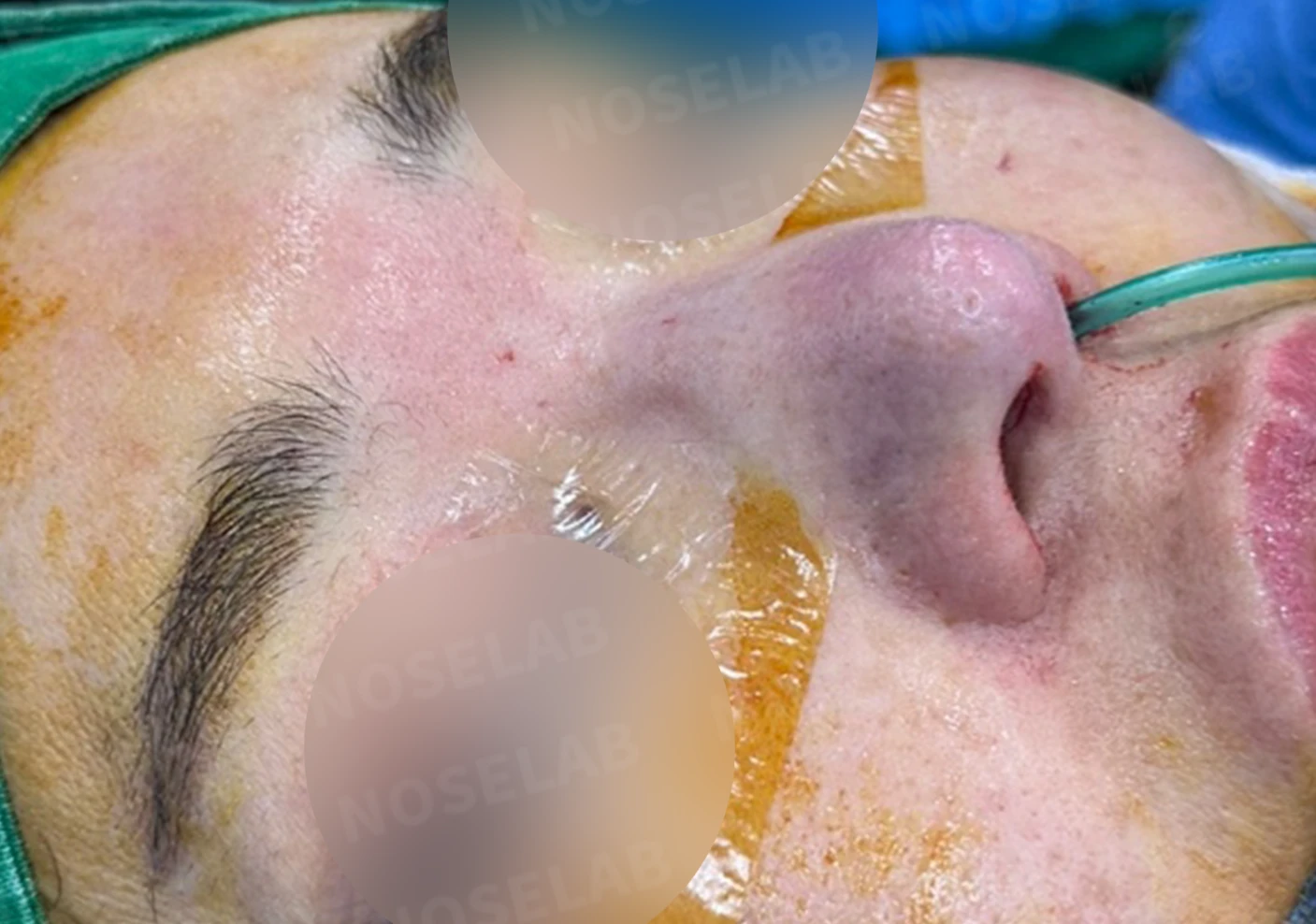 코재수술에서 비중격을 재건하는 방법 — 본문 사진 7