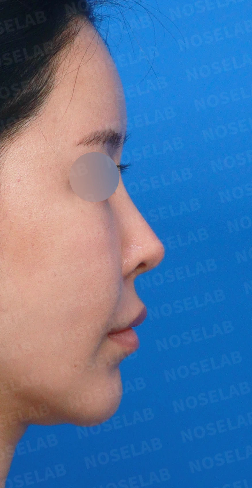 비중격 완전 재건으로 오똑한 코끝과 비공 비대칭 교정 — 디자인 상담 우측 측면, 비스듬한 측면, 비공 사진입니다.