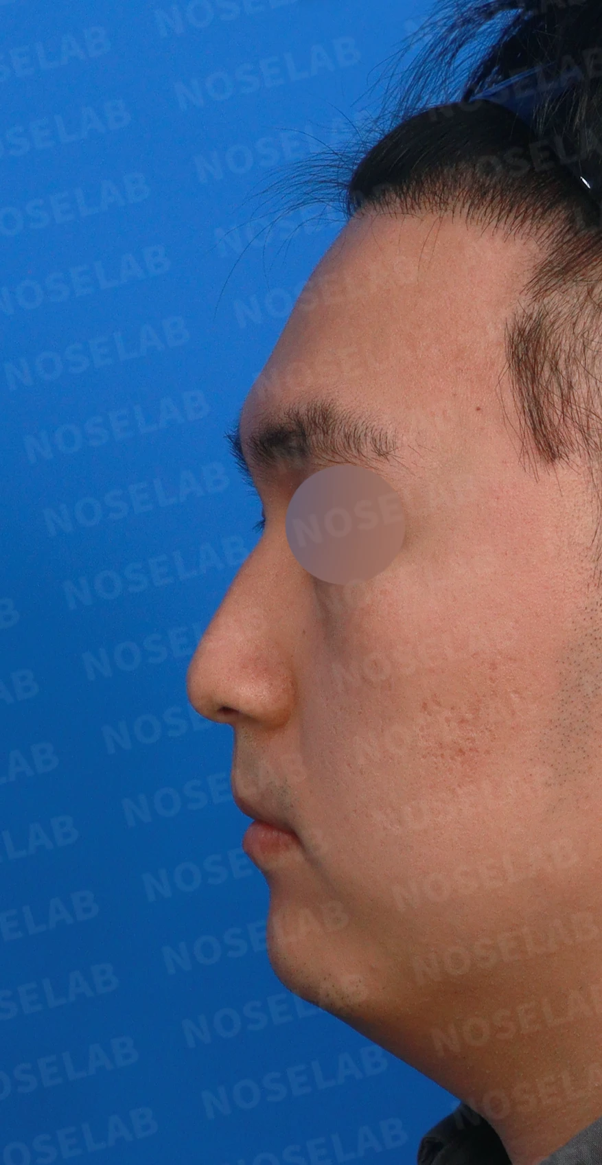 비중격이 휘면 코막힘과 휜 코가 함께 생기는 이유, 재건은 어떻게 하나 — 디자인 상담 정면, 좌측 측면, 비스듬한 측면 사진입니다.