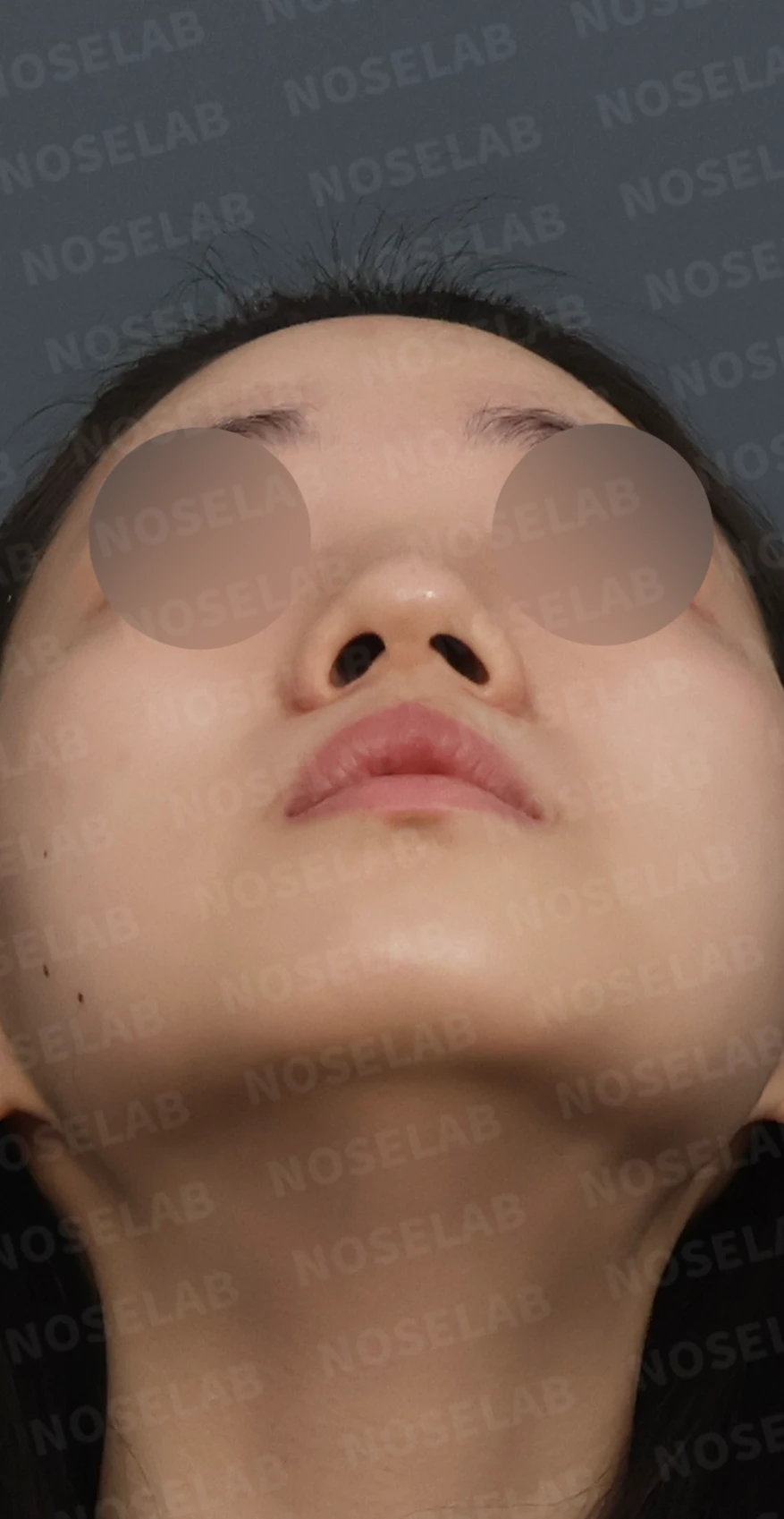 복코와 주먹코, 자가늑연골로 얄쌍하고 여성스러운 코 완성 — 디자인 상담 우측 측면, 비스듬한 측면, 비공 사진입니다.