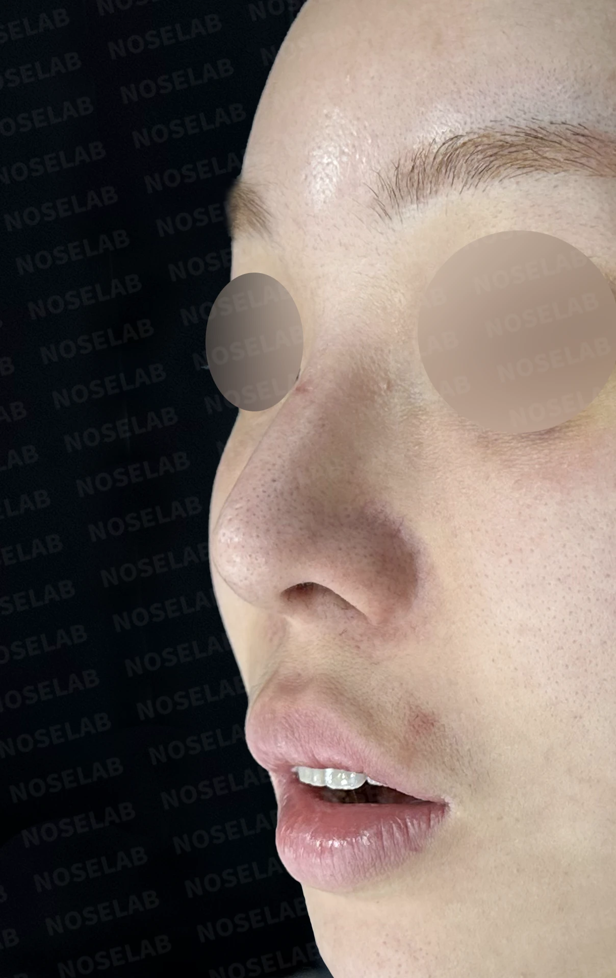 처지고 휘어진 코, 자가늑연골로 비중격 재건하고 코막힘까지 해결한 코재수술 사례 — 전(좌) 직후(후)