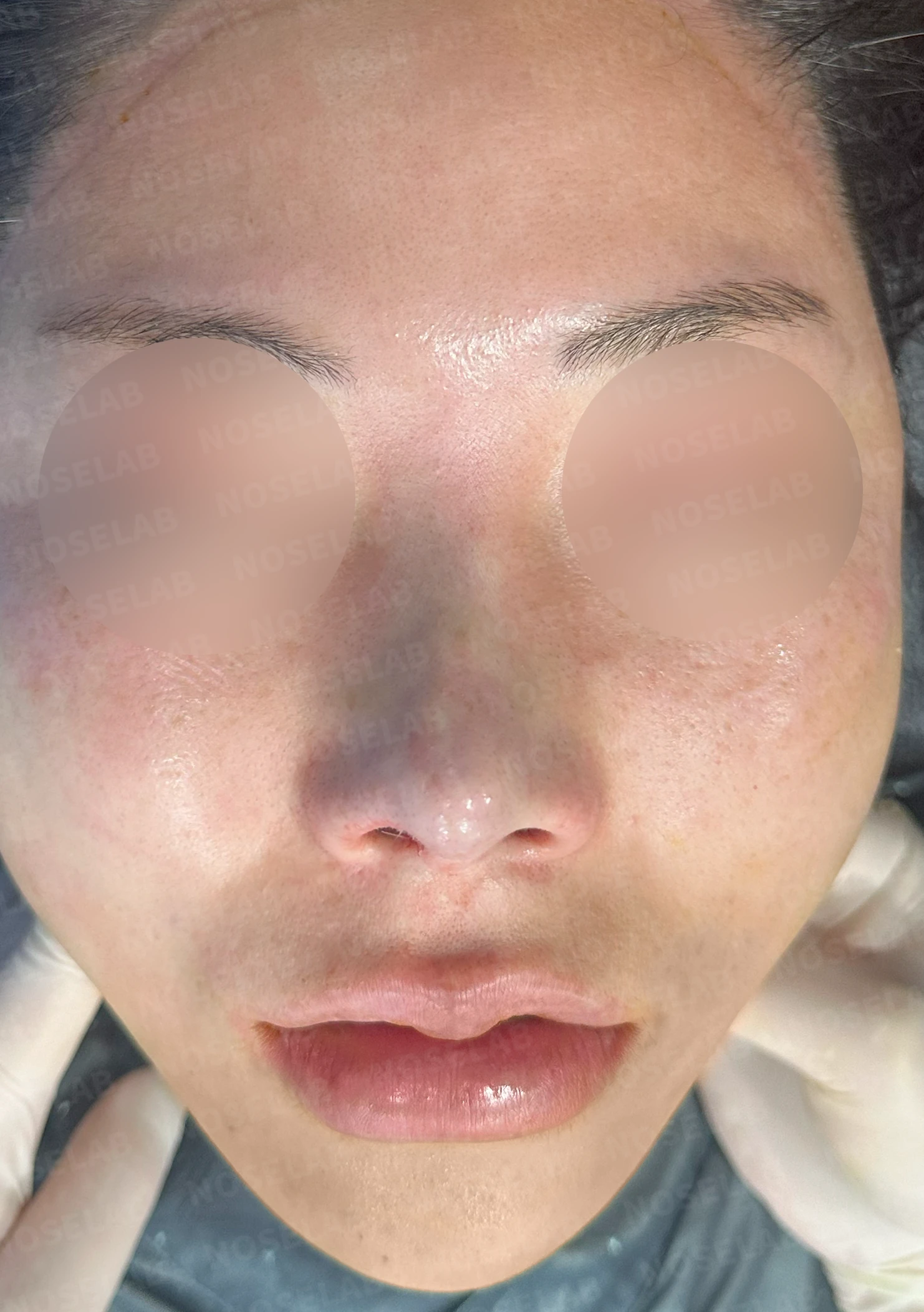 자연스러운 아름다움의 비밀: 들린코와 콧구멍 노출 교정 사례 — 수술전(좌) 수술직후(우)