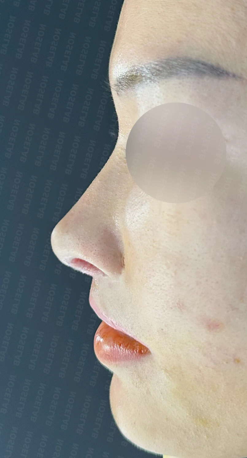 원하는 코 모양과 현재 구조를 함께 살펴보는 수술 계획 — 수술 전 / 수술 직후 0일 직후 사진은 부기가 있는 상태로 최종 결과와 다를 수 있습니다.