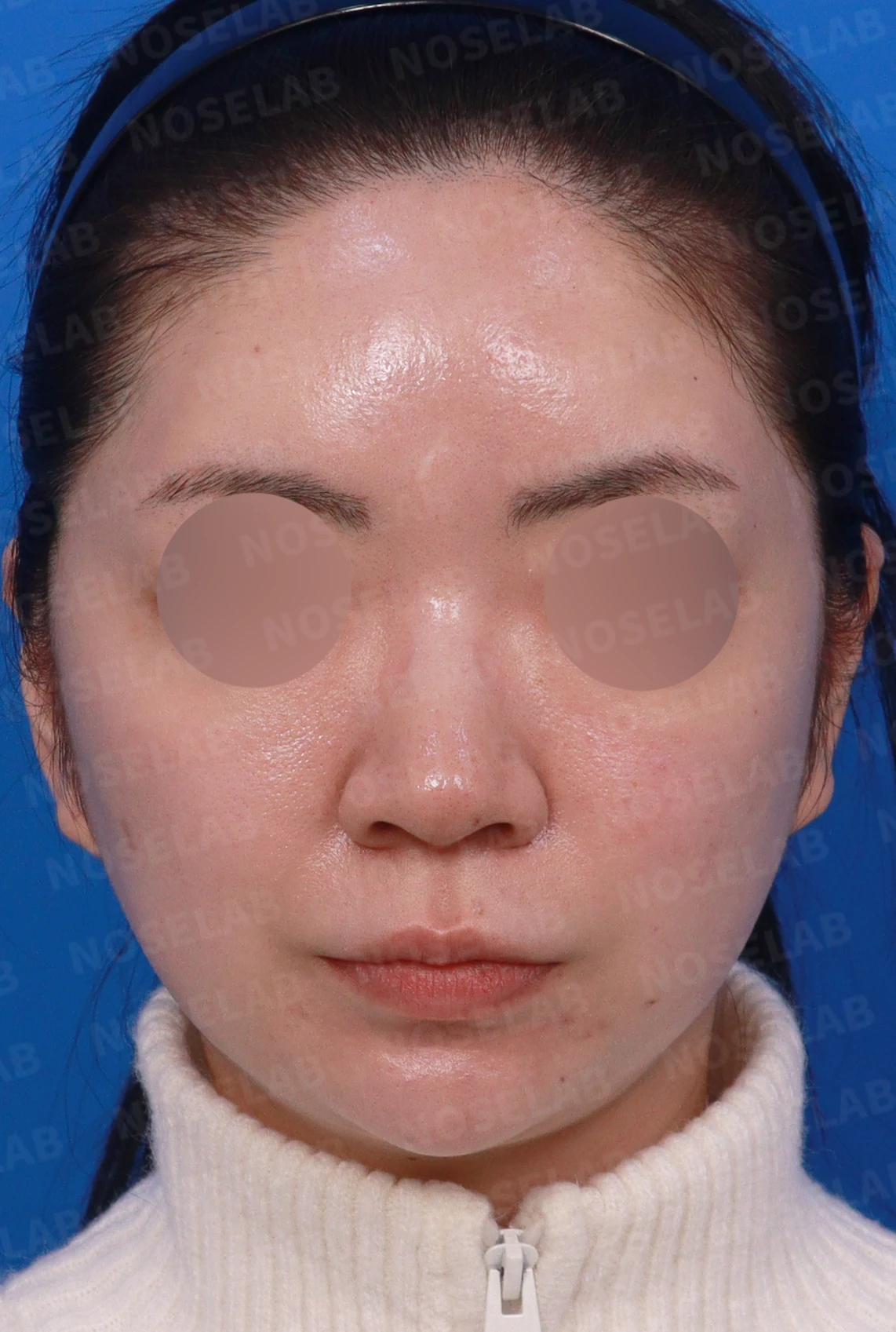 코끝이 퍼져 보이는 이유와 코바닥·비순각을 함께 다루는 방법 — 디자인 상담 정면, 좌측 측면, 비스듬한 측면 사진입니다.