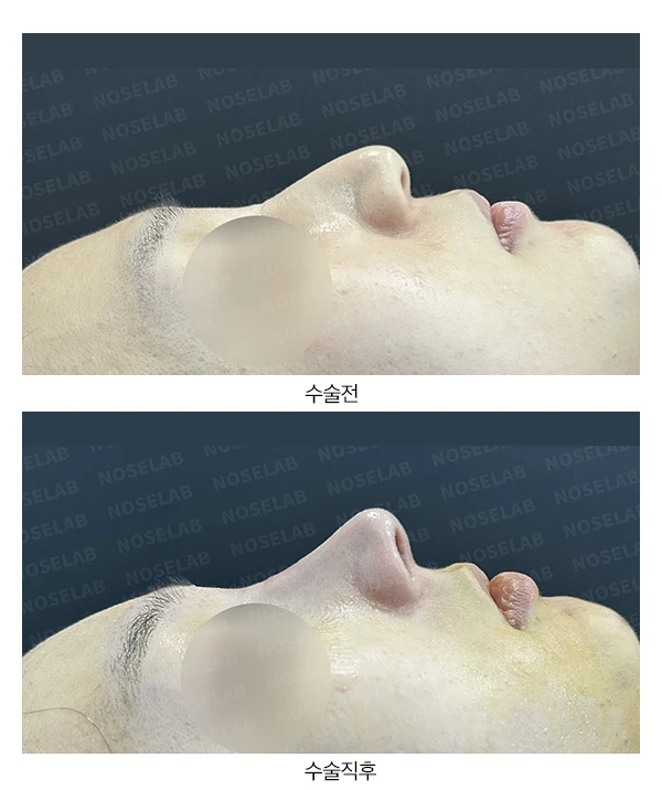 뭉툭한 처진코 교정 방법 — 전후 비교