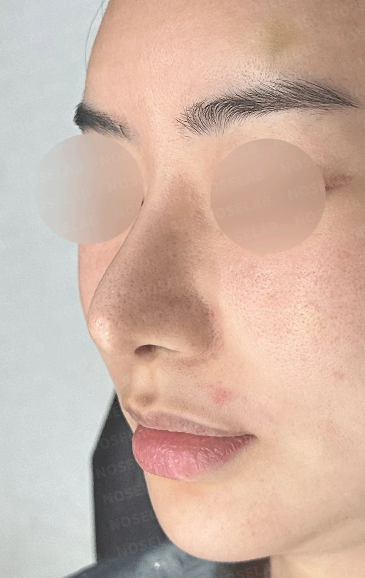 코가 과하게 높아져 부자연스러워 보이고 휘는 이유, 재건은 어떻게 하나 — 수술 전 / 수술 직후 0일 직후 사진은 부기가 있는 상태로 최종 결과와 다를 수 있습니다.