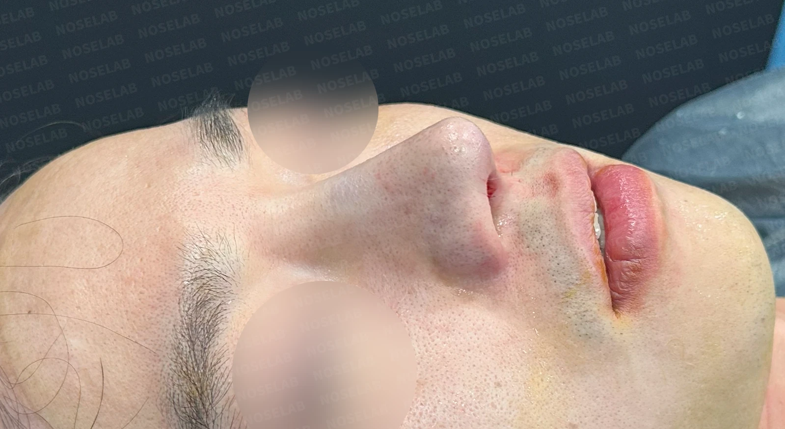 복코와 퍼진 코의 코성형 방법 — 수술 전 / 수술 직후 0일 직후 사진은 부기가 있는 상태로 최종 결과와 다를 수 있습니다.