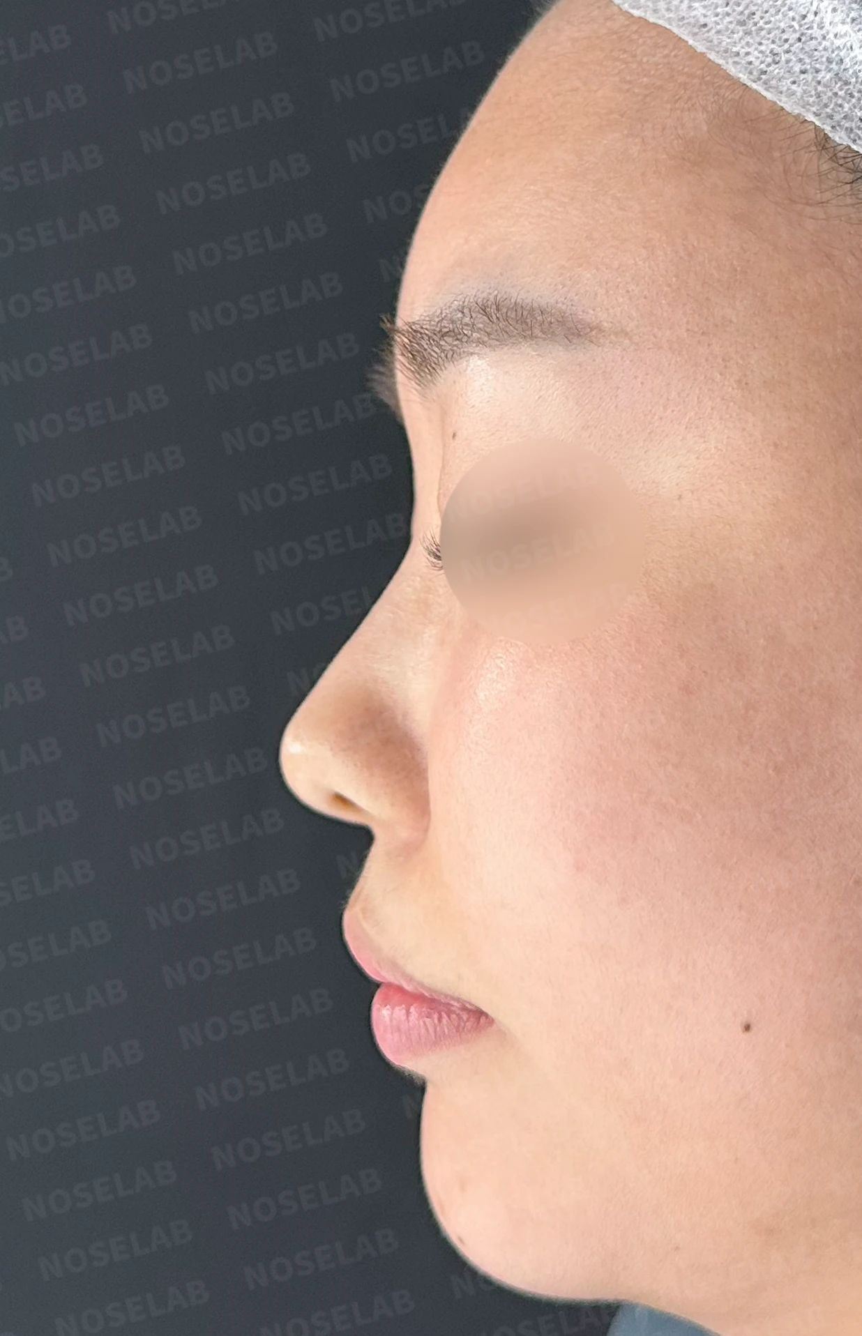 비염 수술을 받았는데도 코막힘이 돌아오는 이유, 구조 교정은 어떻게 하나 — 수술 전 / 수술 직후 0일 직후 사진은 부기가 있는 상태로 최종 결과와 다를 수 있습니다.