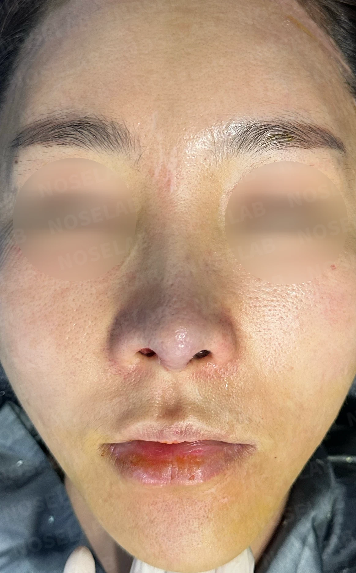 긴 코의 길이와 코끝을 함께 교정하는 방법 — 수술 전 / 수술 직후 0일 직후 사진은 부기가 있는 상태로 최종 결과와 다를 수 있습니다.