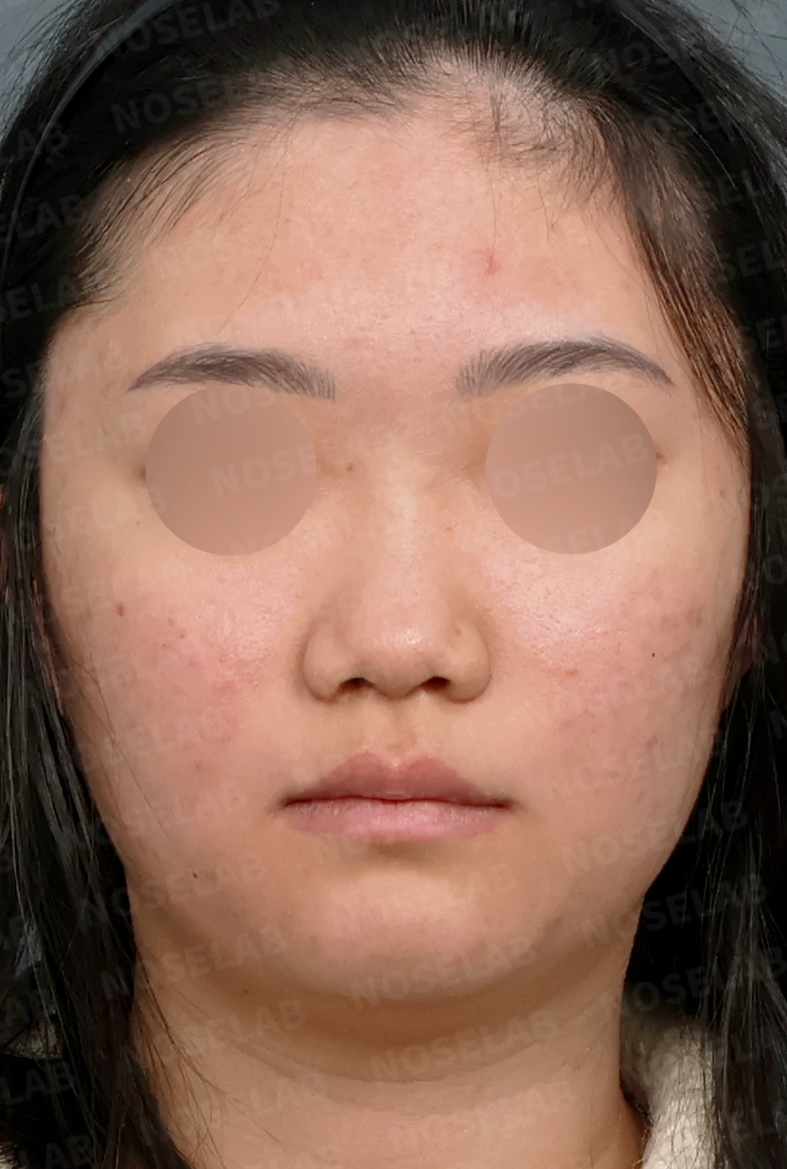 콧대가 낮고 코끝이 뭉툭해 보이는 이유, 함몰된 비주와 함께 교정하는 방법 — 디자인 상담 정면, 좌측 측면, 비스듬한 측면 사진입니다.