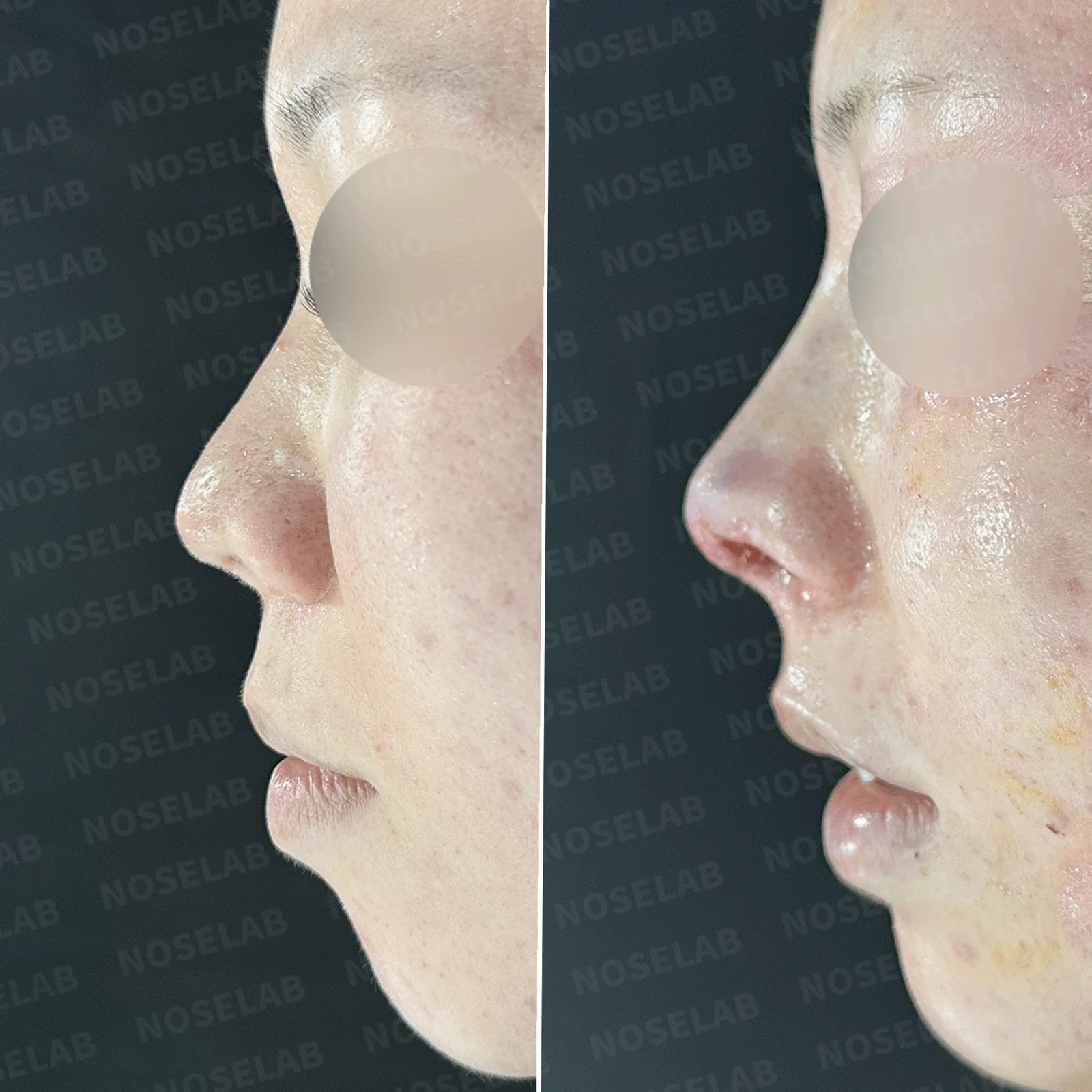 콧구멍을 막는 종괴가 생기는 이유, 제거와 재건은 어떻게 하나 — 본문 사진 28