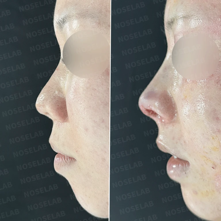 수술 불가 판정받은 콧구멍 종괴 완전 제거 - 만성염증성 조직 제거 및 재건술 실제 후기 — 전후 비교