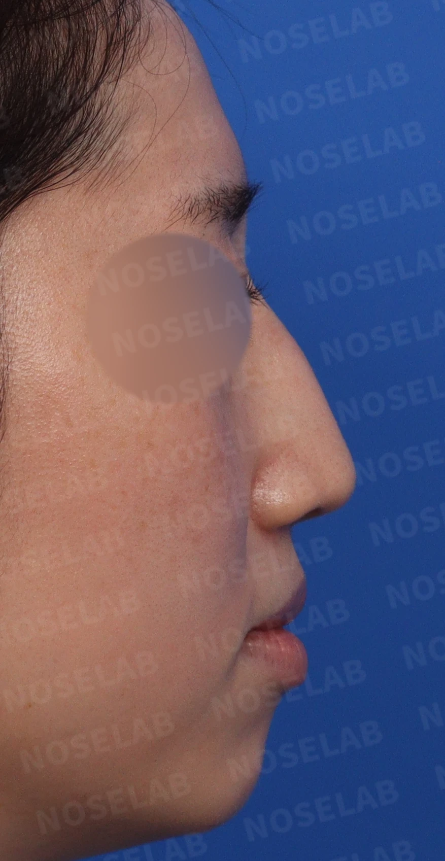 이물질(메쉬·실) 제거후 코성형 방법 — 본문 사진 2