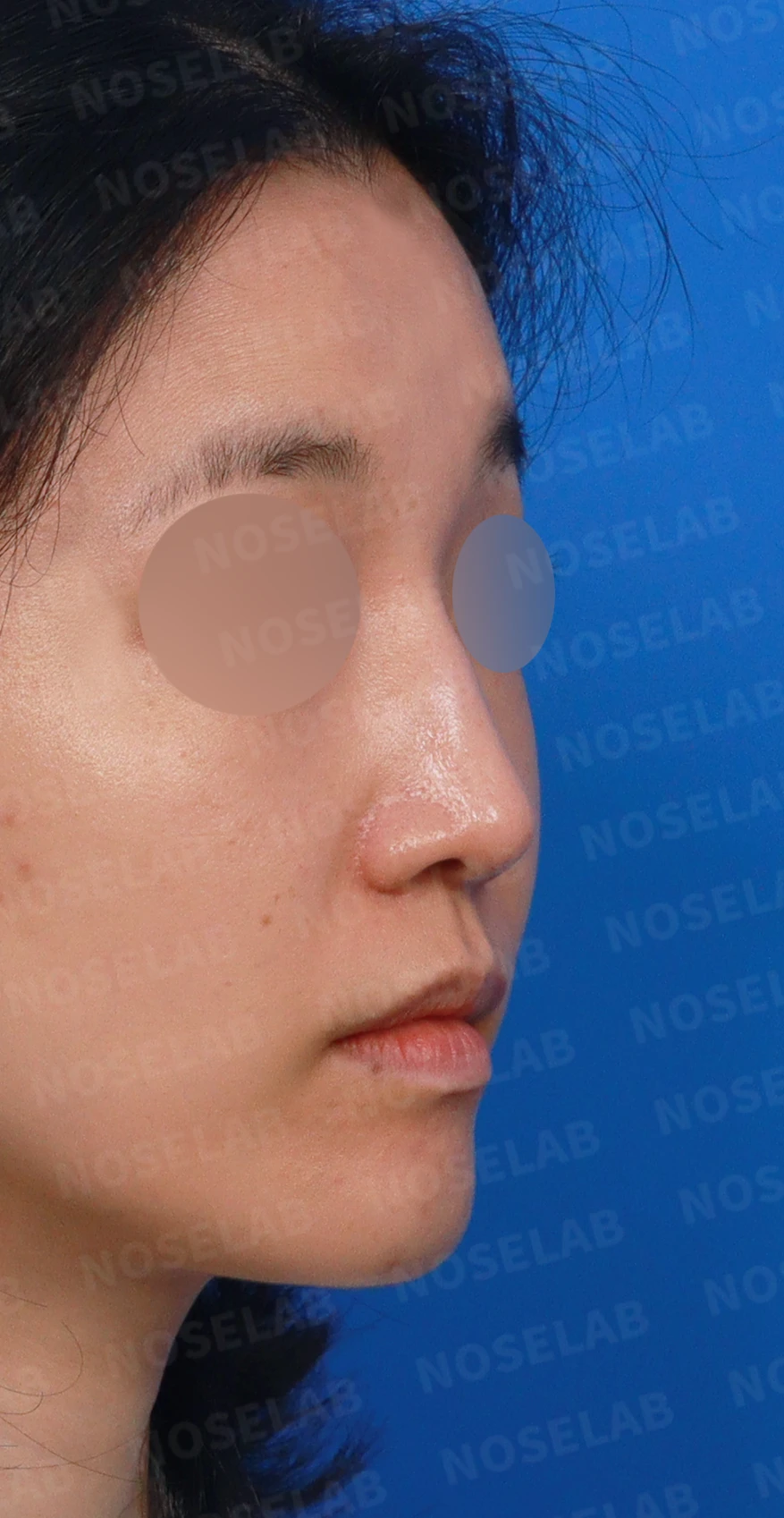 콧대 인공진피가 매부리로 남는 이유와 제거 후 재건 방법 — 디자인 상담 우측 측면, 비스듬한 측면, 비공 사진입니다.