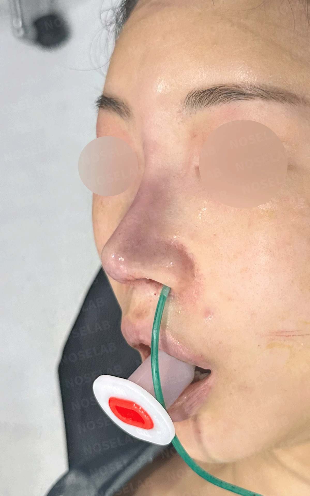 이전 수술로도 달라지지 않는 뭉툭한 코끝, 원인과 재건 방법 — 수술 직후 0일 정면 , 비스듬한 측면 , 측면 사진입니다. 직후 사진은 부기가 있는 상태로 최종 결과와 다를 수 있습니다.