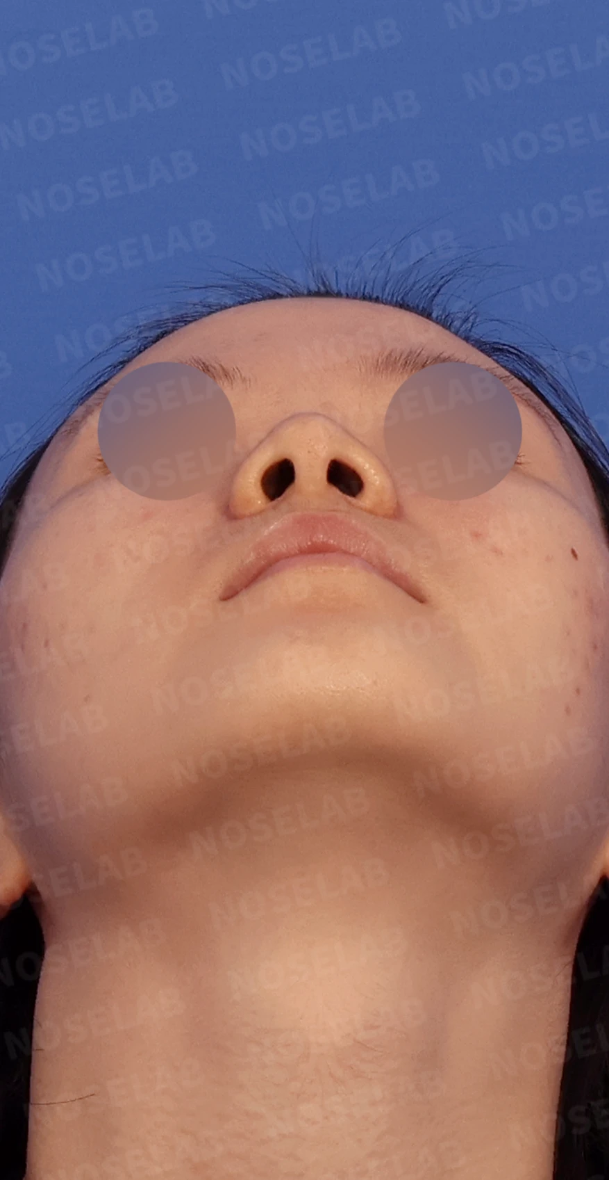콧대가 퍼져 보이고 코끝이 뭉툭한 이유, 절골술과 자가 늑연골 교정은 어떻게 하나 — 디자인 상담 우측 측면, 비스듬한 측면, 비공 사진입니다.