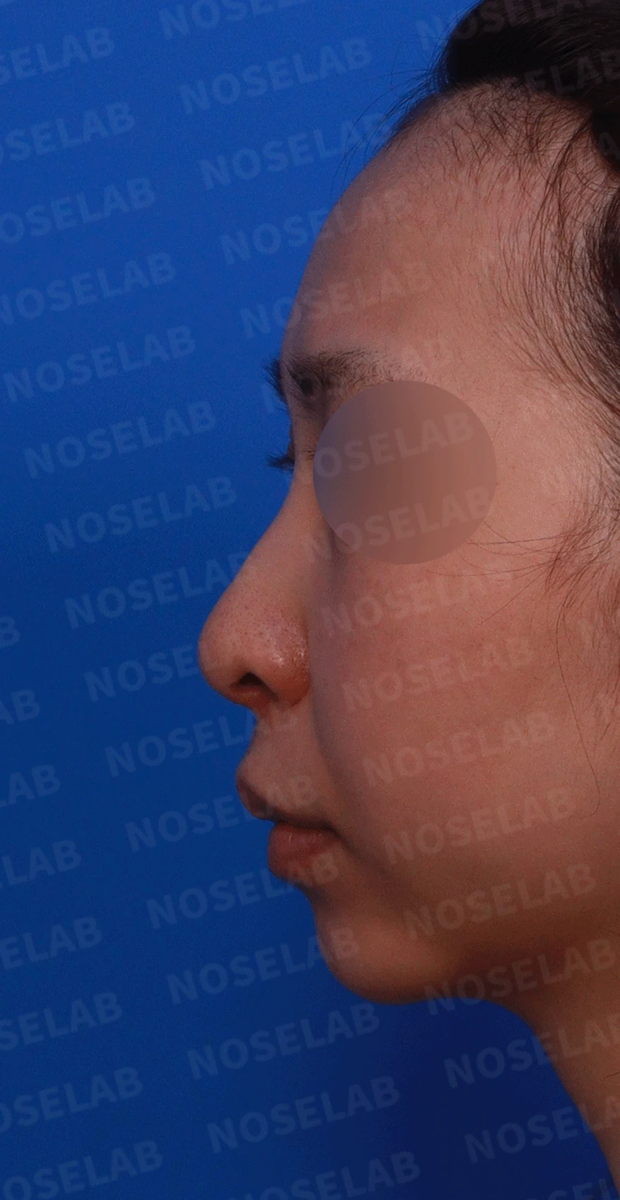 여러 번 수술해도 콧대가 낮고 복코가 남는 이유, 늑연골 재건과 얼굴 균형 — 디자인 상담 정면 , 좌측 비스듬한 측면 , 측면 사진입니다.