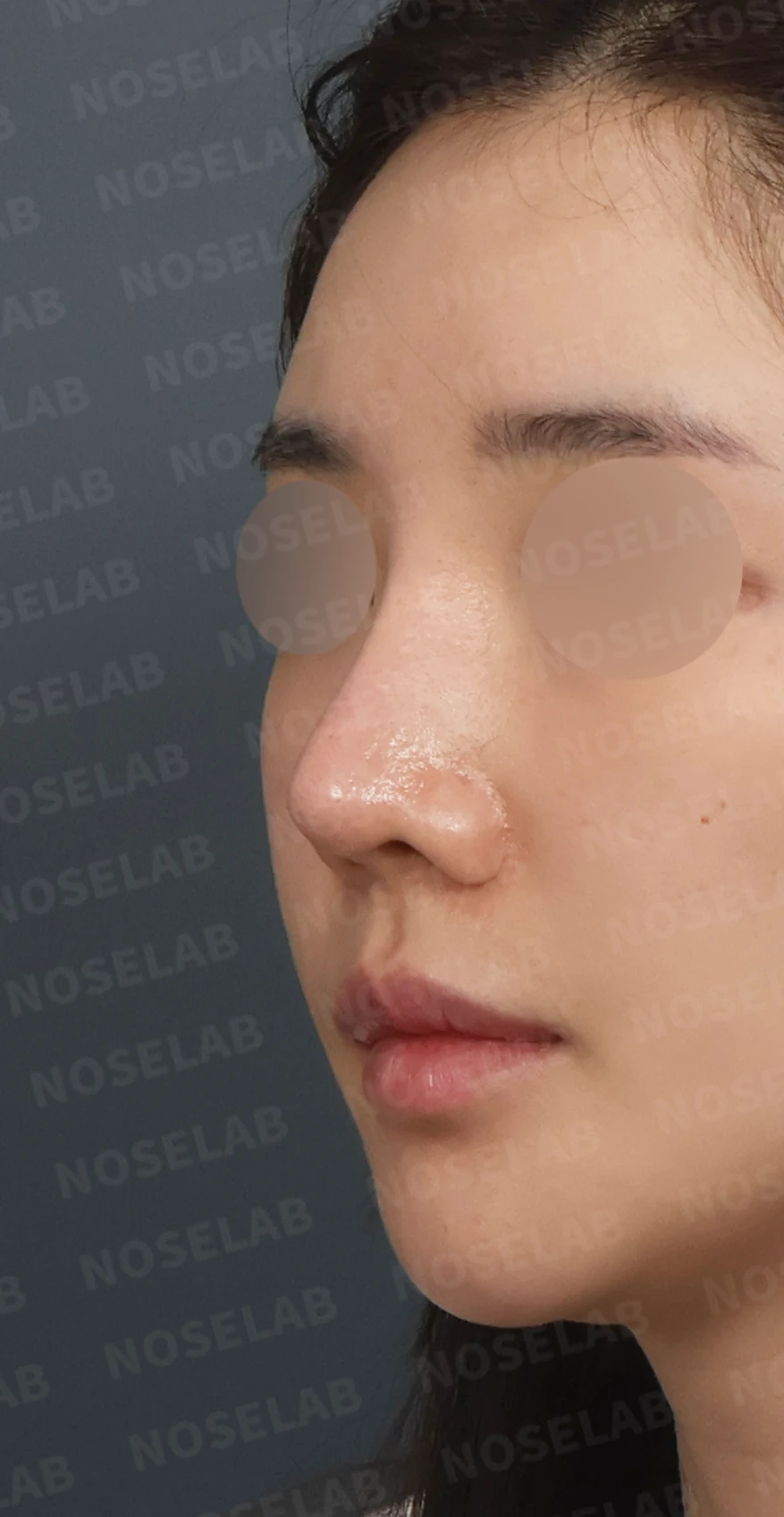 휘어진 코와 퍼진 코끝, 자가늑연골로 세련된 직반라인 완성한 코재수술 — 디자인 상담 정면, 좌측 측면, 비스듬한 측면 사진입니다.