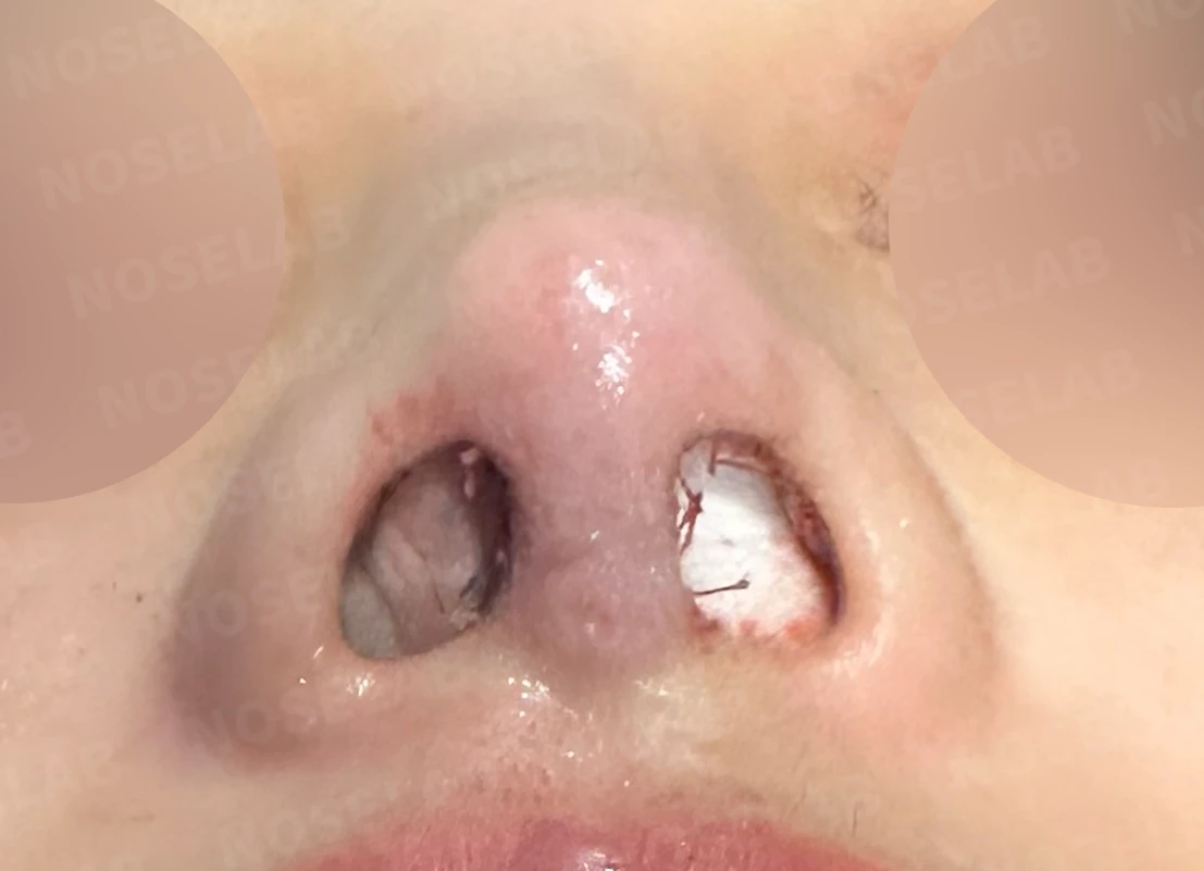 코 안의 메쉬 제거와 자가늑연골 재건 방법 — 수술 직후 0일 콧구멍 사진입니다. 직후 사진은 부기가 있는 상태로 최종 결과와 다를 수 있습니다.