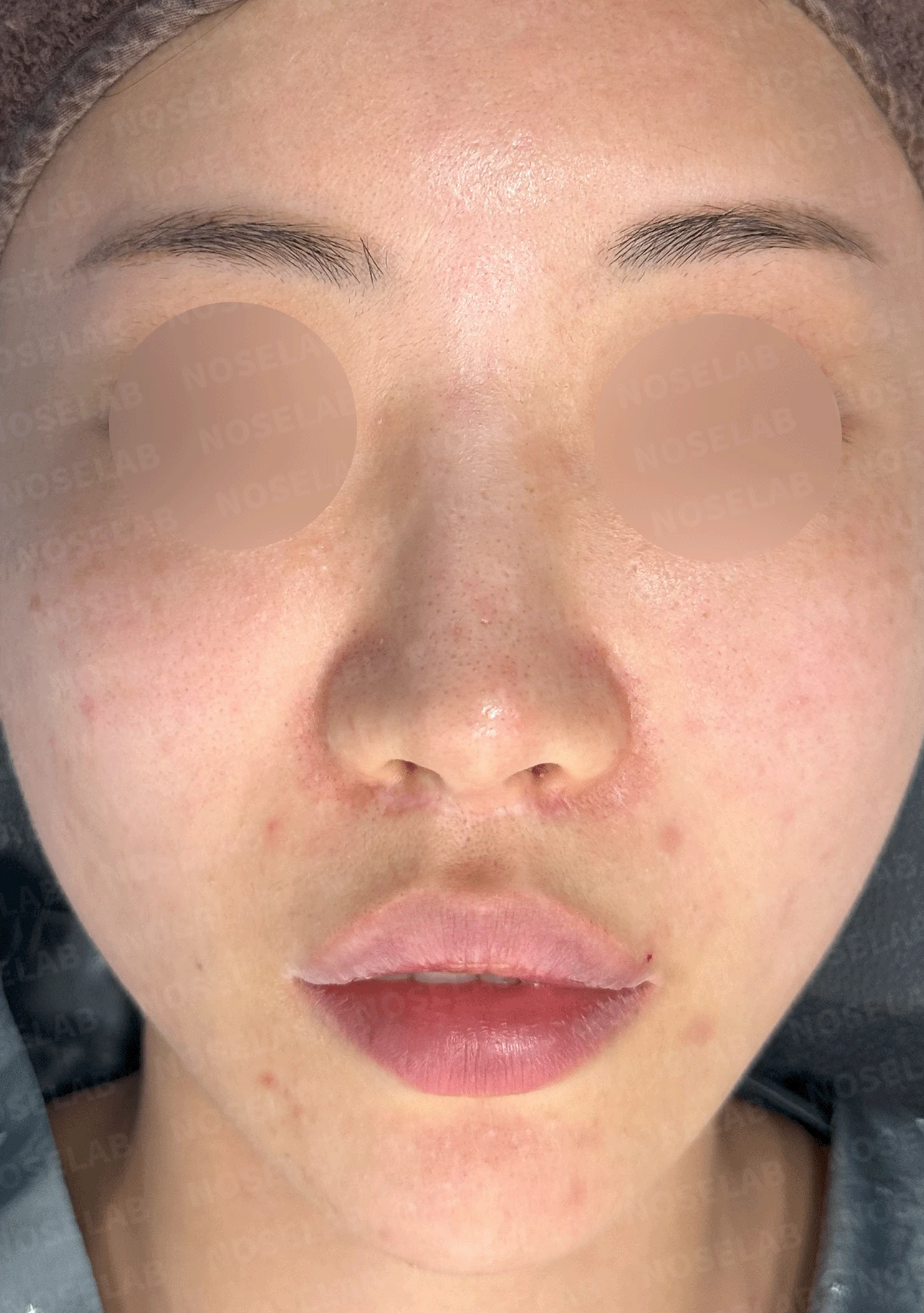 이전 수술로도 달라지지 않는 뭉툭한 코끝, 원인과 재건 방법 — 본문 사진 7