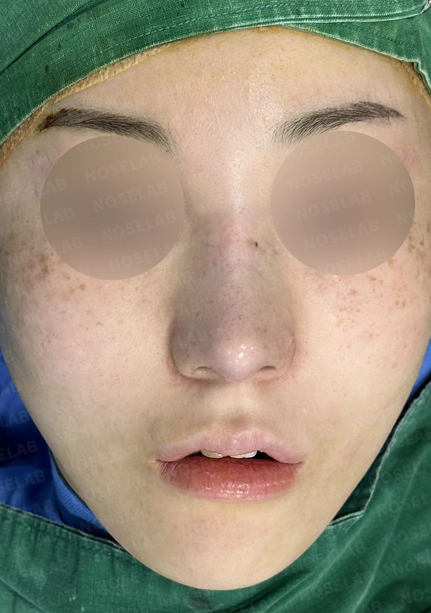 길고 뭉툭한 코, 자가늑연골로 화려하면서 자연스럽게 — 직후 정면, 비스듬한 측면, 측면 사진입니다.