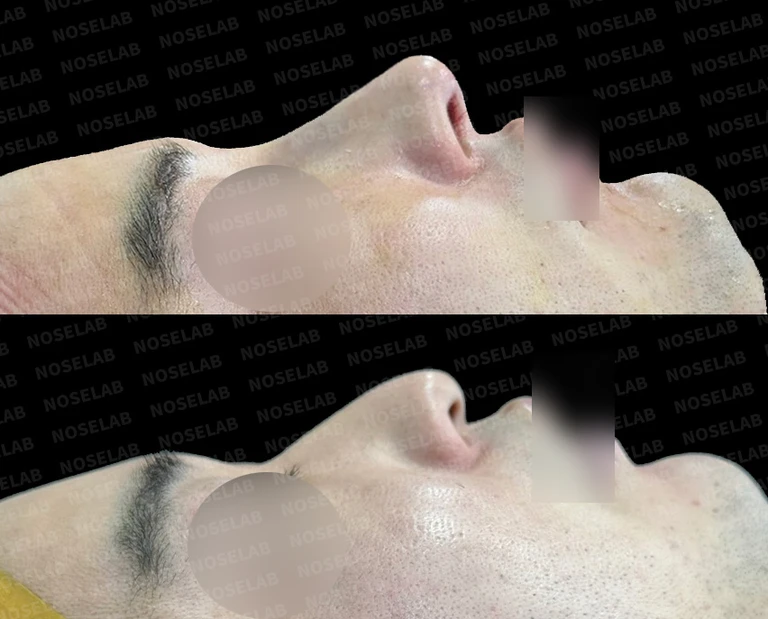 휜 코·매부리 코 교정 수술 방법 — 전후 비교