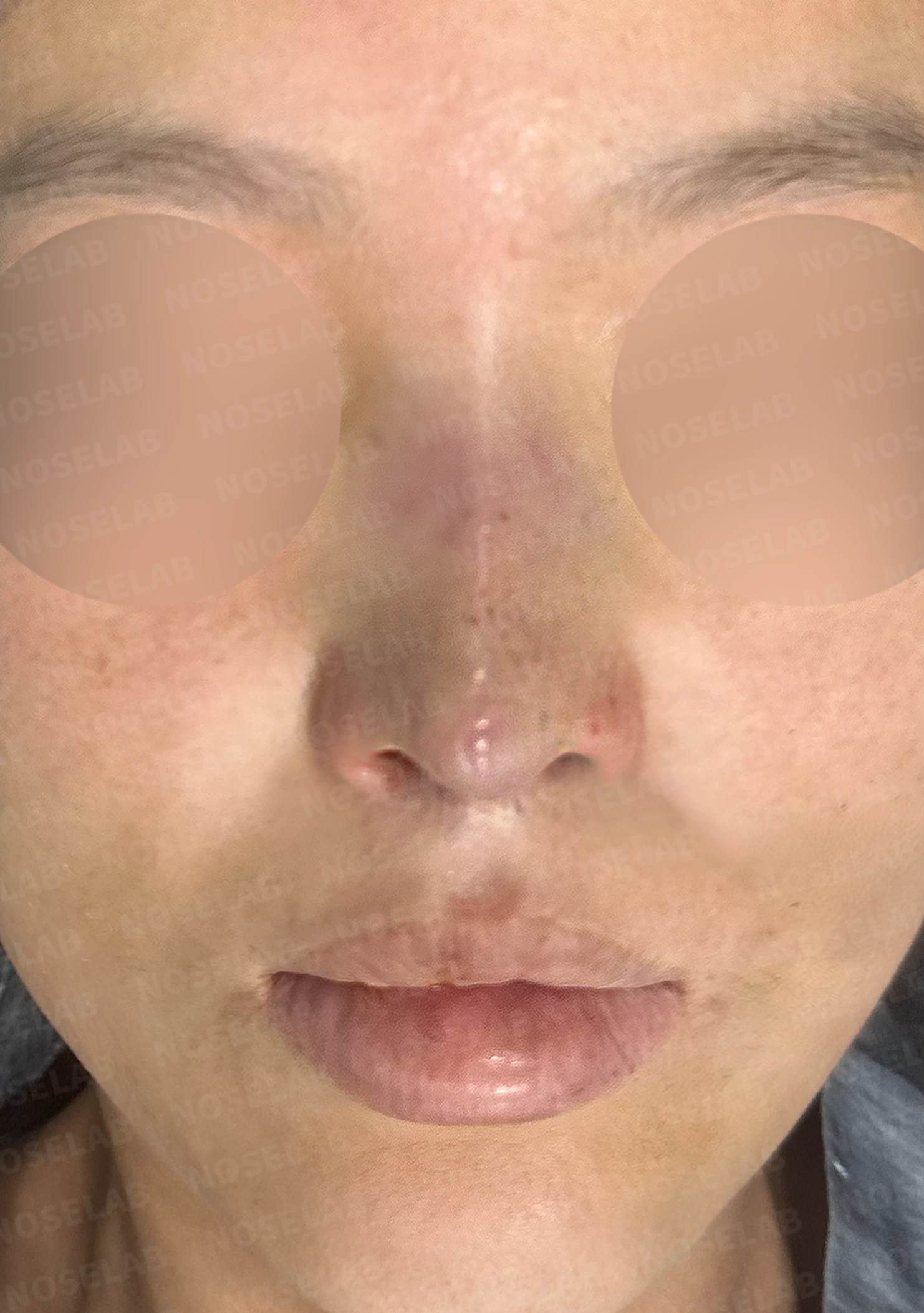 이식한 진피가 흡수되어 콧대가 퍼지고 코가 들려 보이는 이유와 교정 방법 — 수술 직후 0일 정면, 비스듬한 측면, 측면 사진입니다. 직후 사진은 부기가 있는 상태로 최종 결과와 다를 수 있습니다.