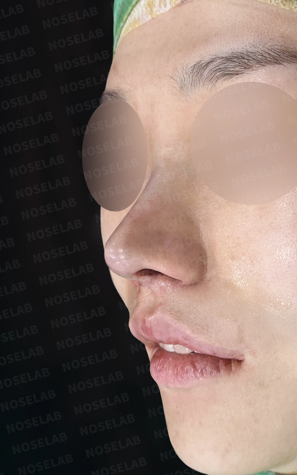 콧구멍 좌우가 심하게 달라 보이는 이유, 연골 재건과 피부이식 교정은 어떻게 하나 — 수술 전 / 수술 직후 0일 직후 사진은 부기가 있는 상태로 최종 결과와 다를 수 있습니다.