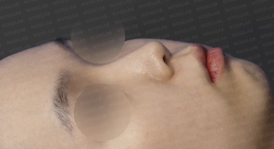 짧은 코의 비개방 교정 방법과 얼굴 비율 — 수술 전 / 수술 직후 0일 직후 사진은 부기가 있는 상태로 최종 결과와 다를 수 있습니다.