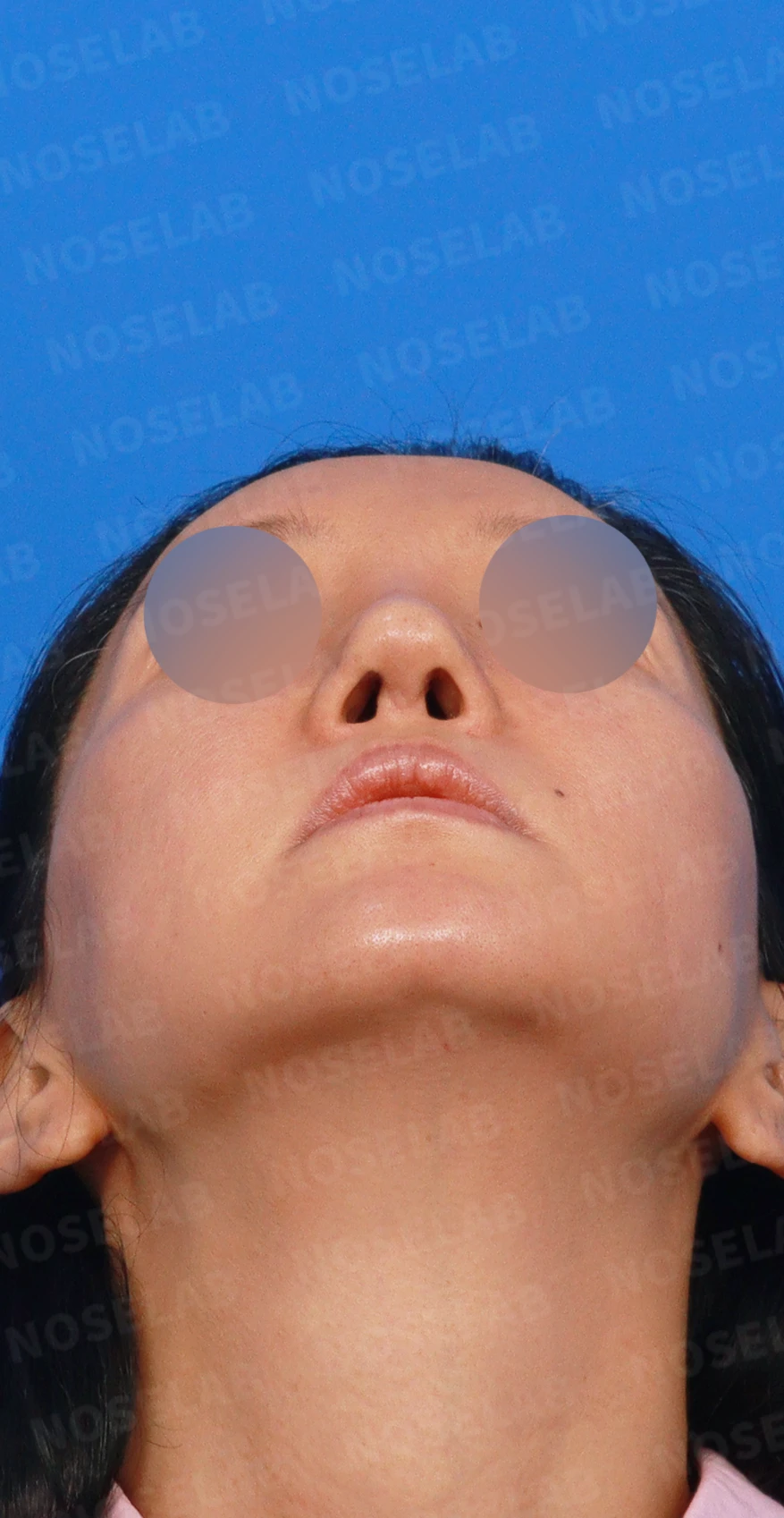 여러 번의 코재수술 뒤 비중격이 무너지는 이유, 자가늑연골 전면 재건은 어떻게 하나 — 디자인 상담 우측 측면, 비스듬한 측면, 비공 사진입니다.