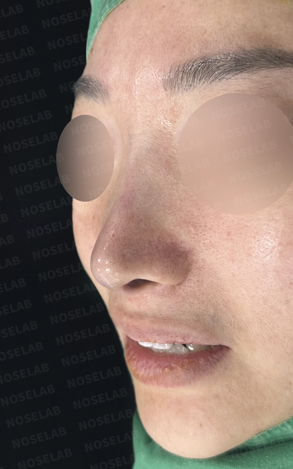 비중격이 한쪽으로 무너지면 코가 휘고 숨이 막히는 이유, 자가늑연골 재건 방법 — 수술 전 / 수술 직후 0일 직후 사진은 부기가 있는 상태로 최종 결과와 다를 수 있습니다.