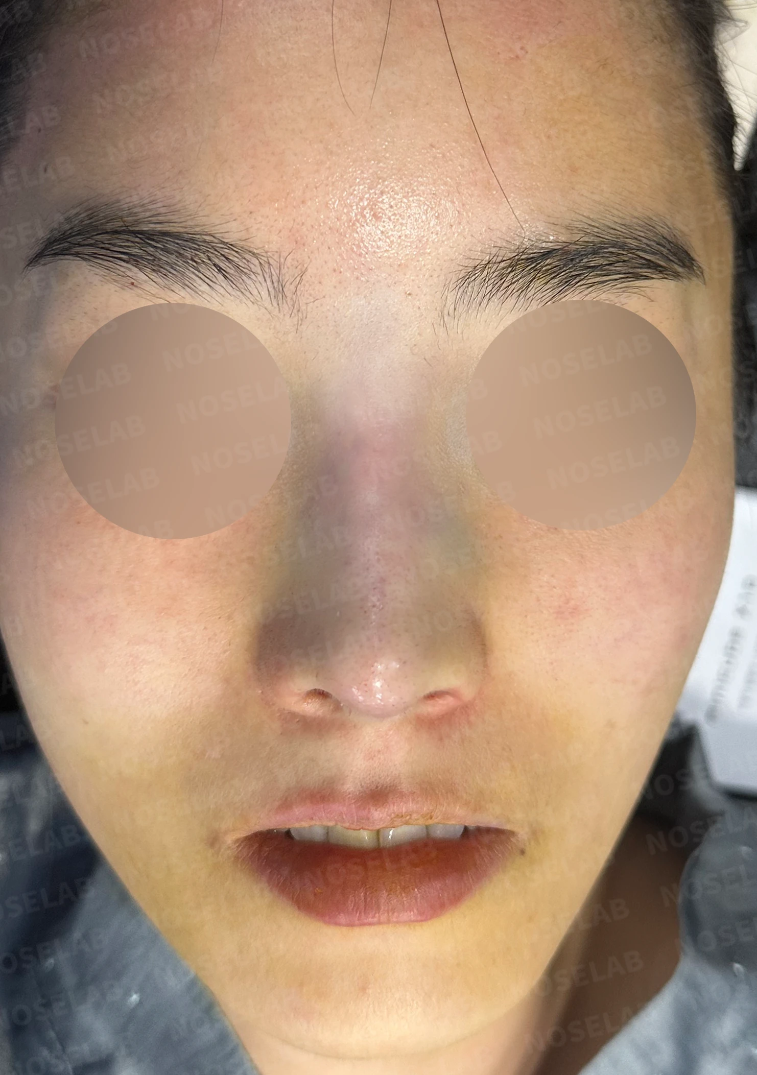 여러 차례 받은 코필러가 남긴 퍼진 코와 코막힘, 어떻게 정리하나 — 수술 직후 0일 정면, 측면, 비스듬한 측면 사진 직후 사진은 부기가 있는 상태로 최종 결과와 다를 수 있습니다.
