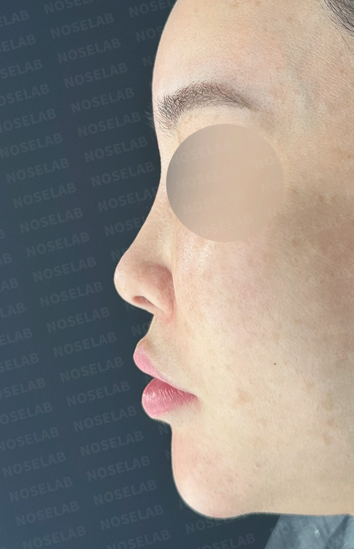 제거했다던 주사 이물질이 남는 이유와 들린 코끝 교정 방법 — 본문 사진 12