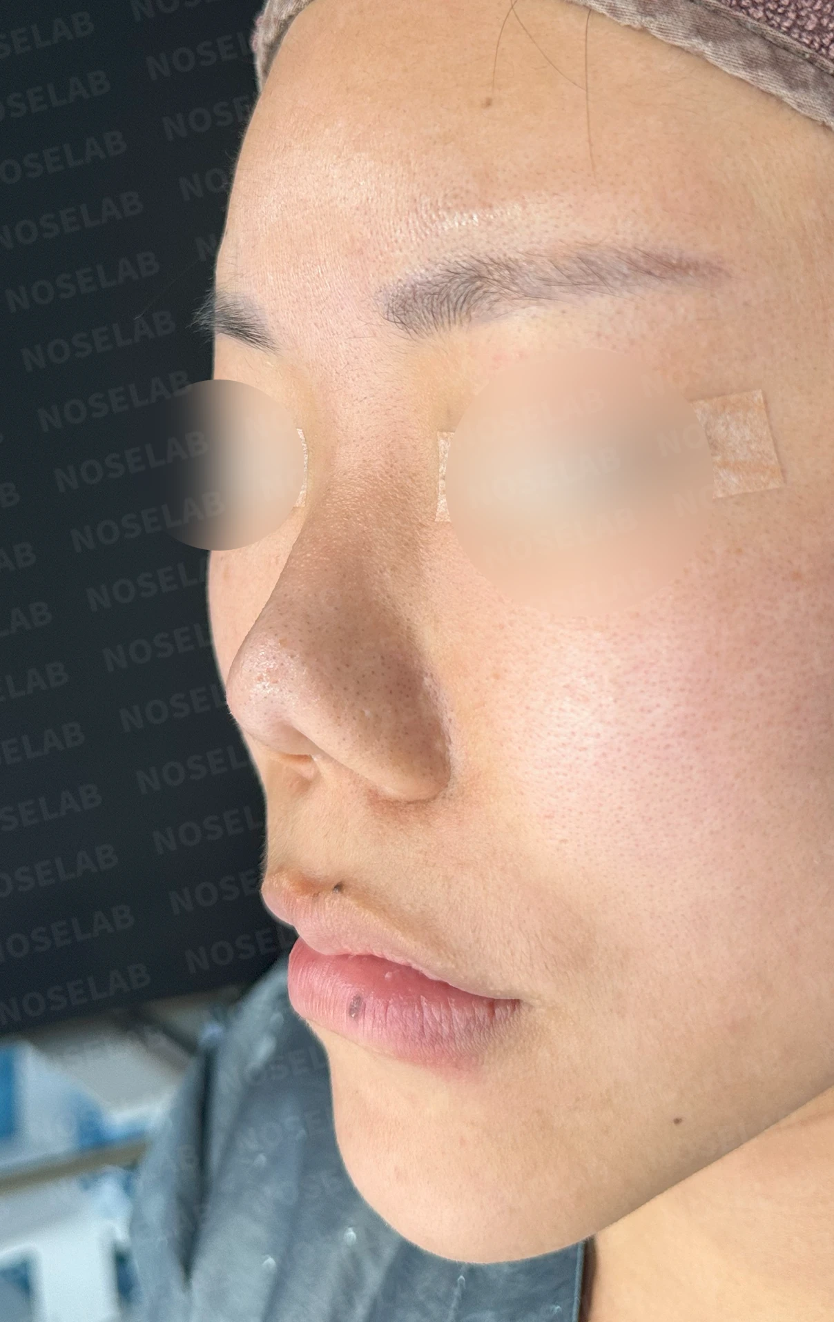 코성형 뒤 감염이 반복되는 이유, 염증 치료와 단계적 재건은 어떻게 하나 — 수술 전 / 수술 직후 0일 직후 사진은 부기가 있는 상태로 최종 결과와 다를 수 있습니다.