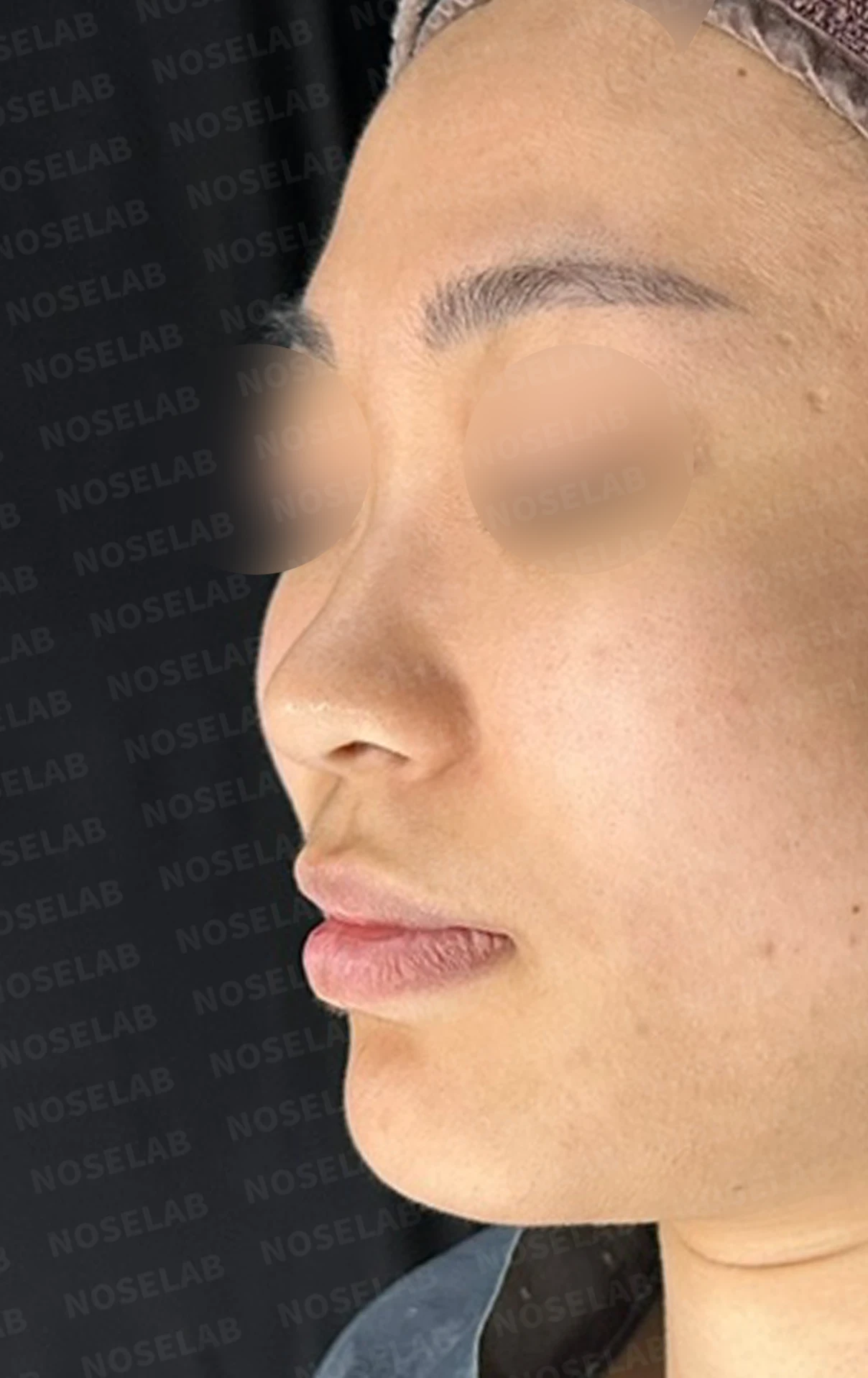 뭉툭하게 퍼진 코끝이 생기는 이유, 자가 늑연골 비중격 연장으로 직반 라인을 만드는 방법 — 수술 전 / 수술 직후 0일 직후 사진은 부기가 있는 상태로 최종 결과와 다를 수 있습니다.