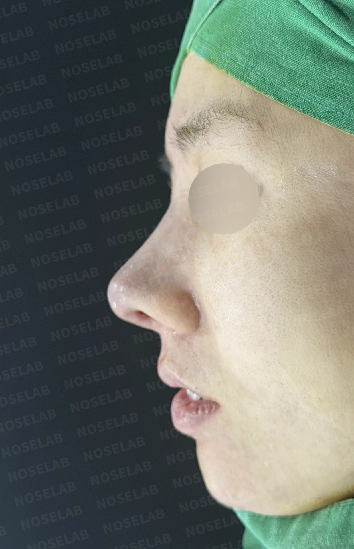이전 수술 뒤 코가 딱딱해지고 짧아지는 구축, 왜 생기고 어떻게 재건하나 — 수술 전 / 수술 직후 0일 직후 사진은 부기가 있는 상태로 최종 결과와 다를 수 있습니다.