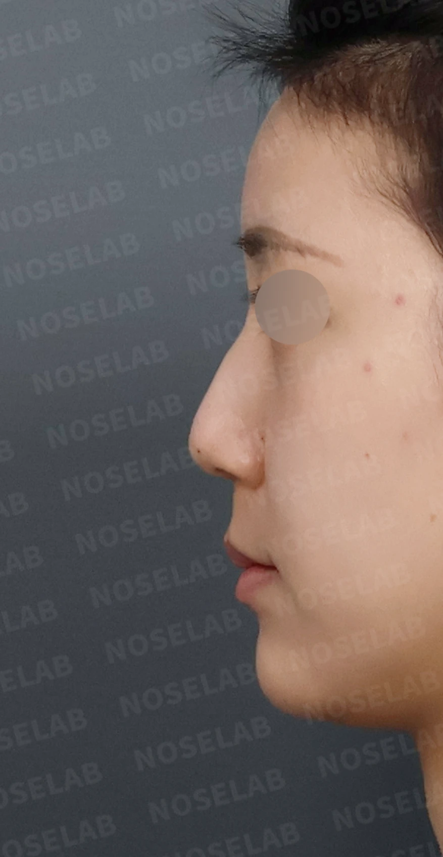 코필러 제거 후 자가늑연골 코성형, 처진 코끝과 메부리코를 자연스럽게 교정 — 디자인 상담 정면, 좌측 측면, 비스듬한 측면 사진입니다.