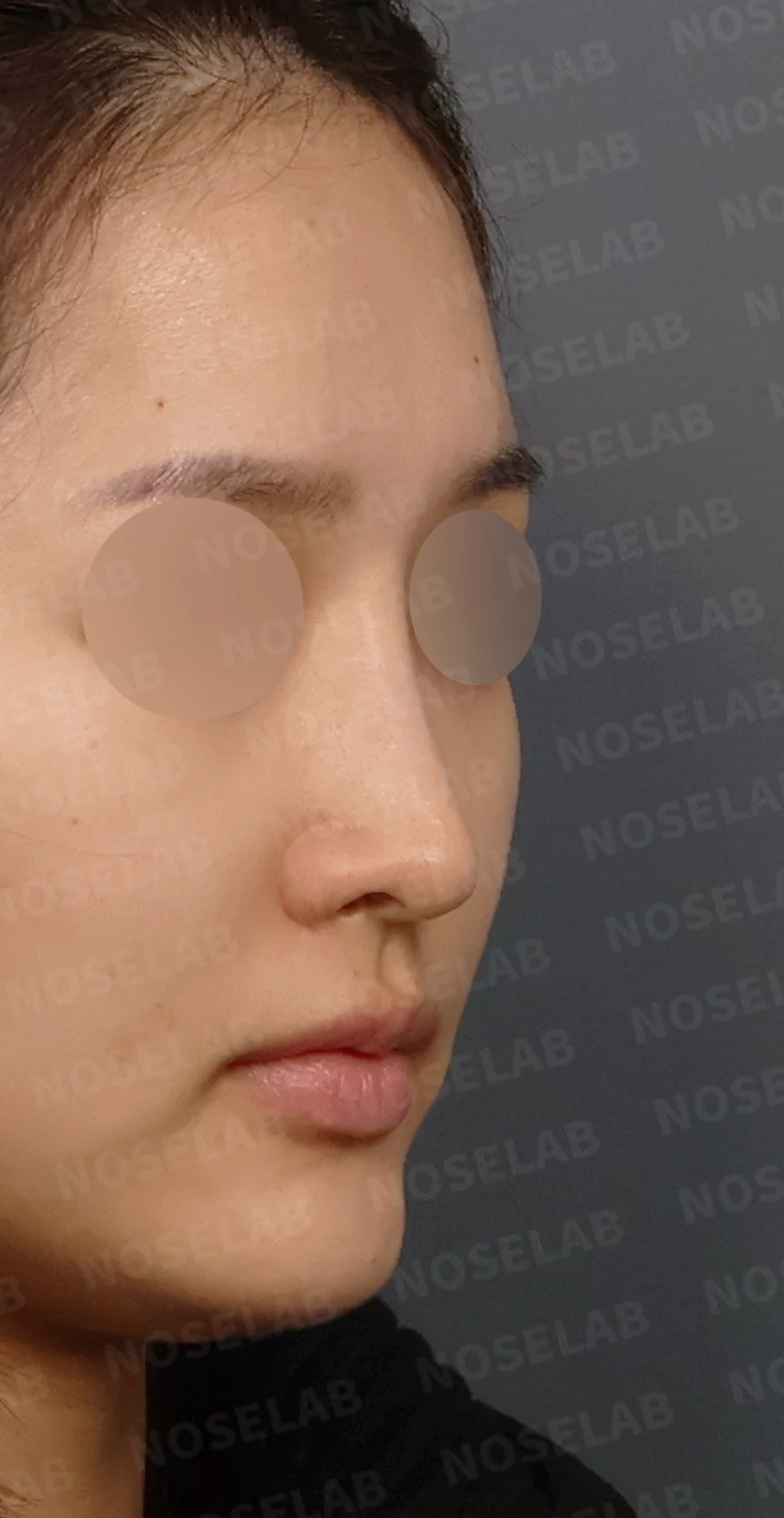코성형 뒤 코끝이 처져 코가 길어 보이는 이유, 자가늑연골 코끝 재건 방법 — 디자인 상담 우측 측면, 비스듬한 측면, 비공 사진입니다.