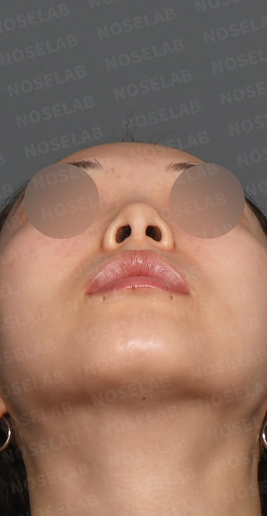 작고 낮은 코, 자가늑연골로 비순각 교정까지 한 번에 완성한 비개방 코성형 — 디자인 상담 우측 측면, 비스듬한 측면, 비공 사진입니다.